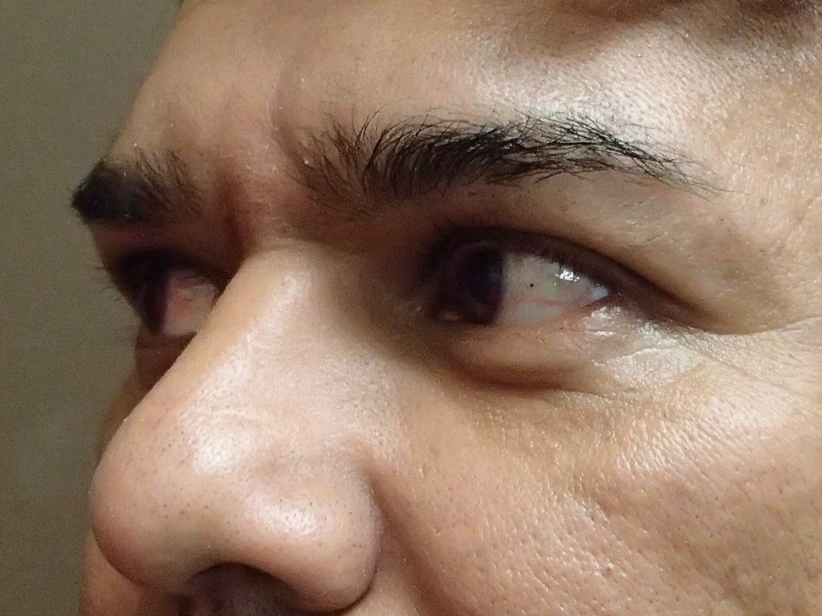 Browlift Before