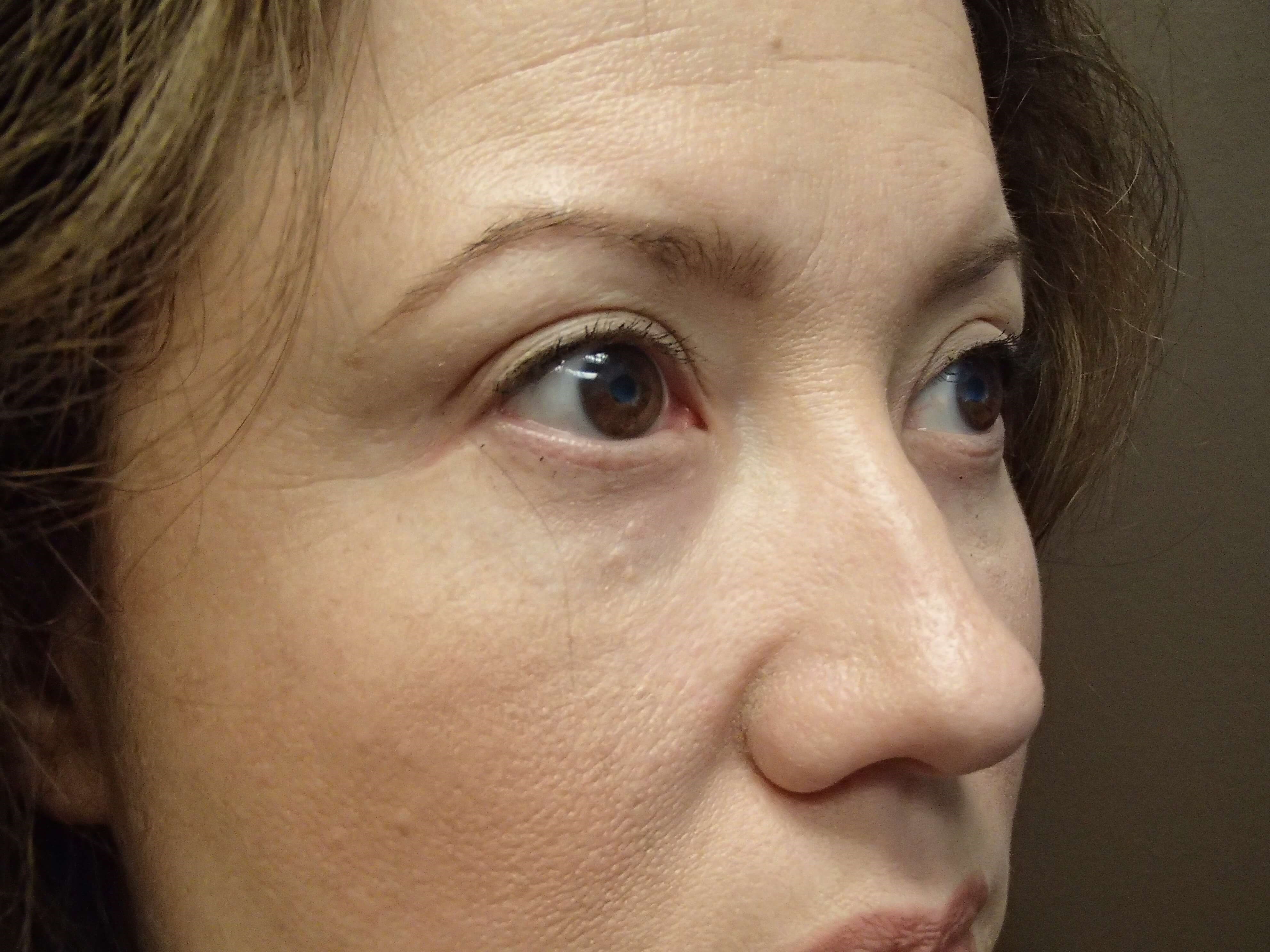 Browlift w/ Eyelid Lift After