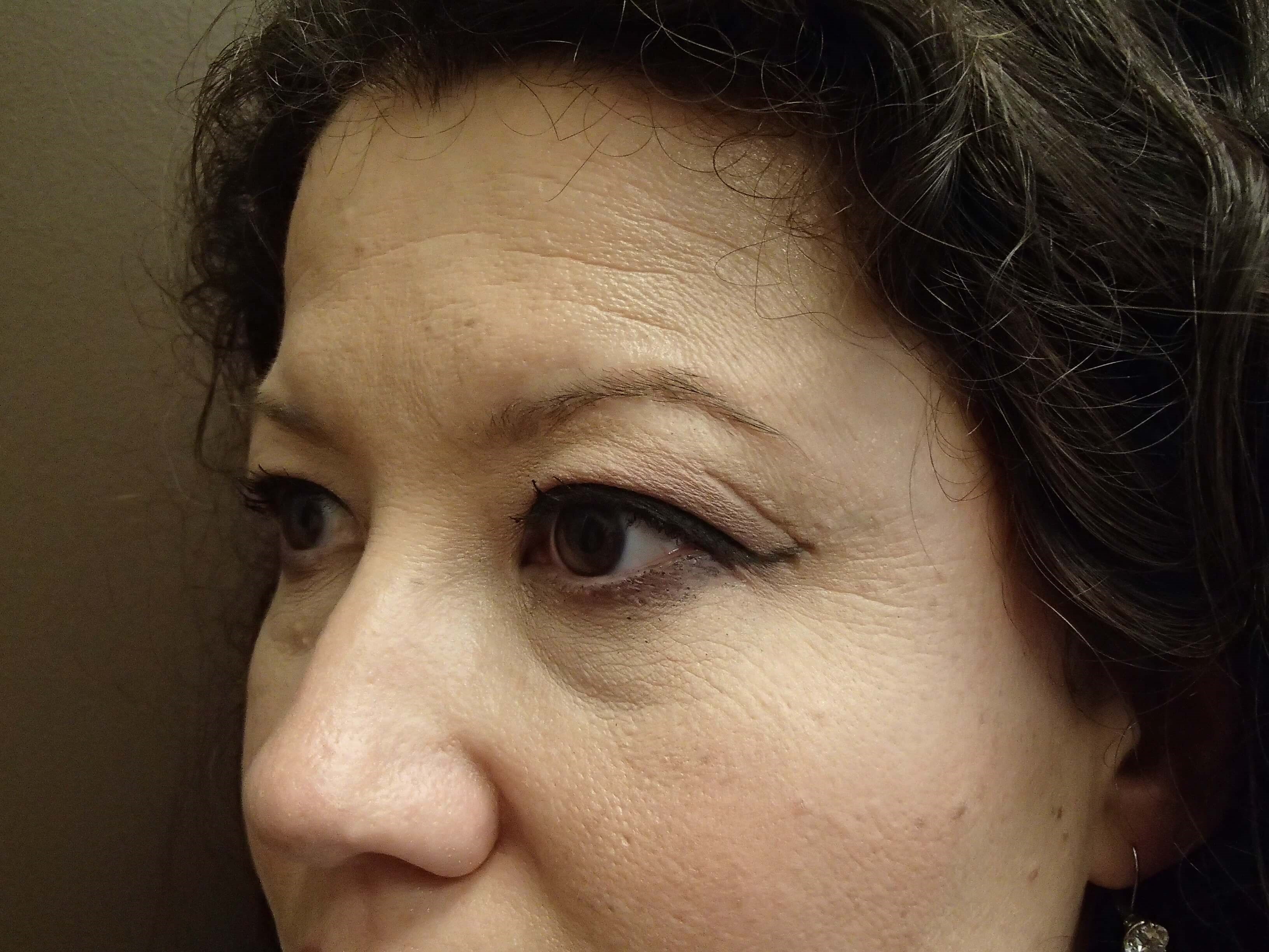 Browlift w/ Eyelid Lift Before
