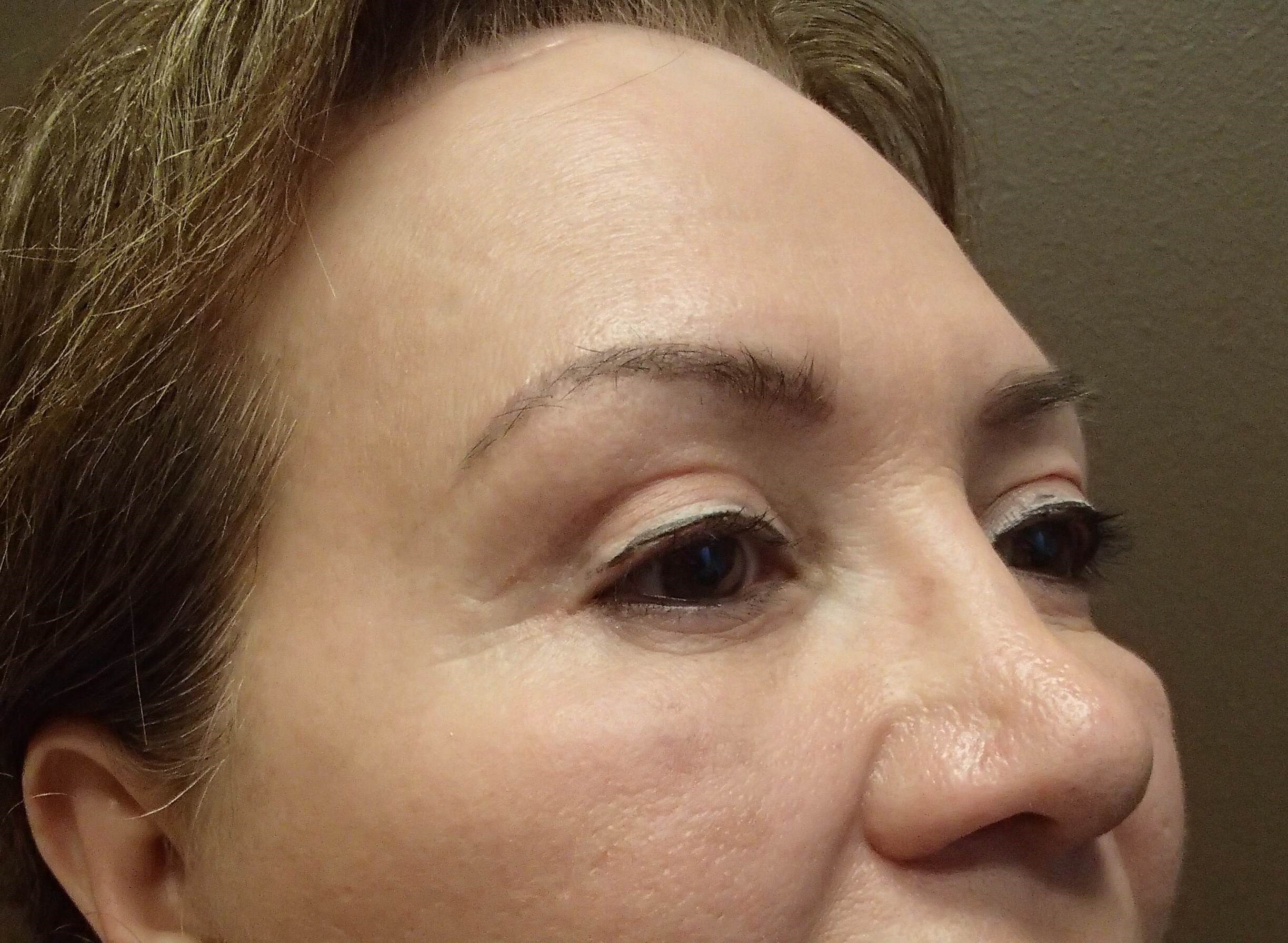 Browlift w/ Eyelid Lift After