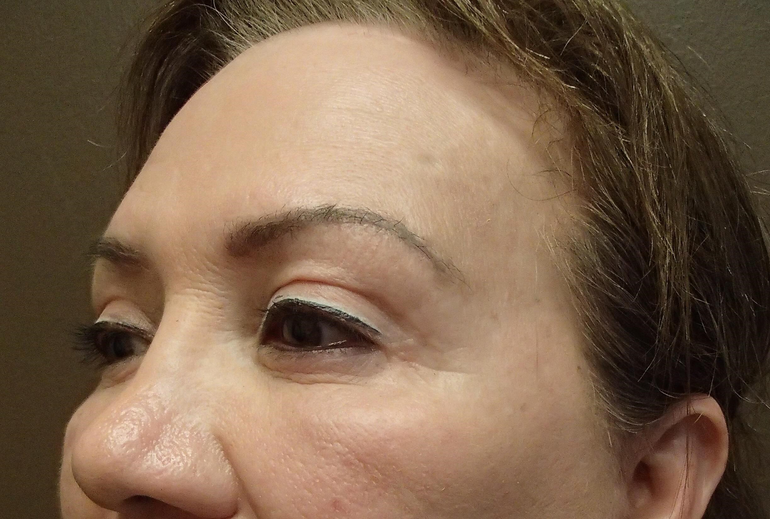 Browlift w/ Eyelid Lift After