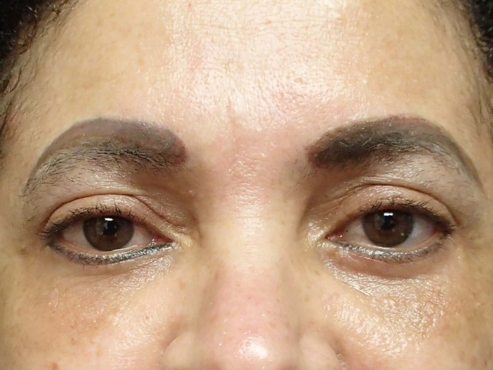 Blepharoplasty After