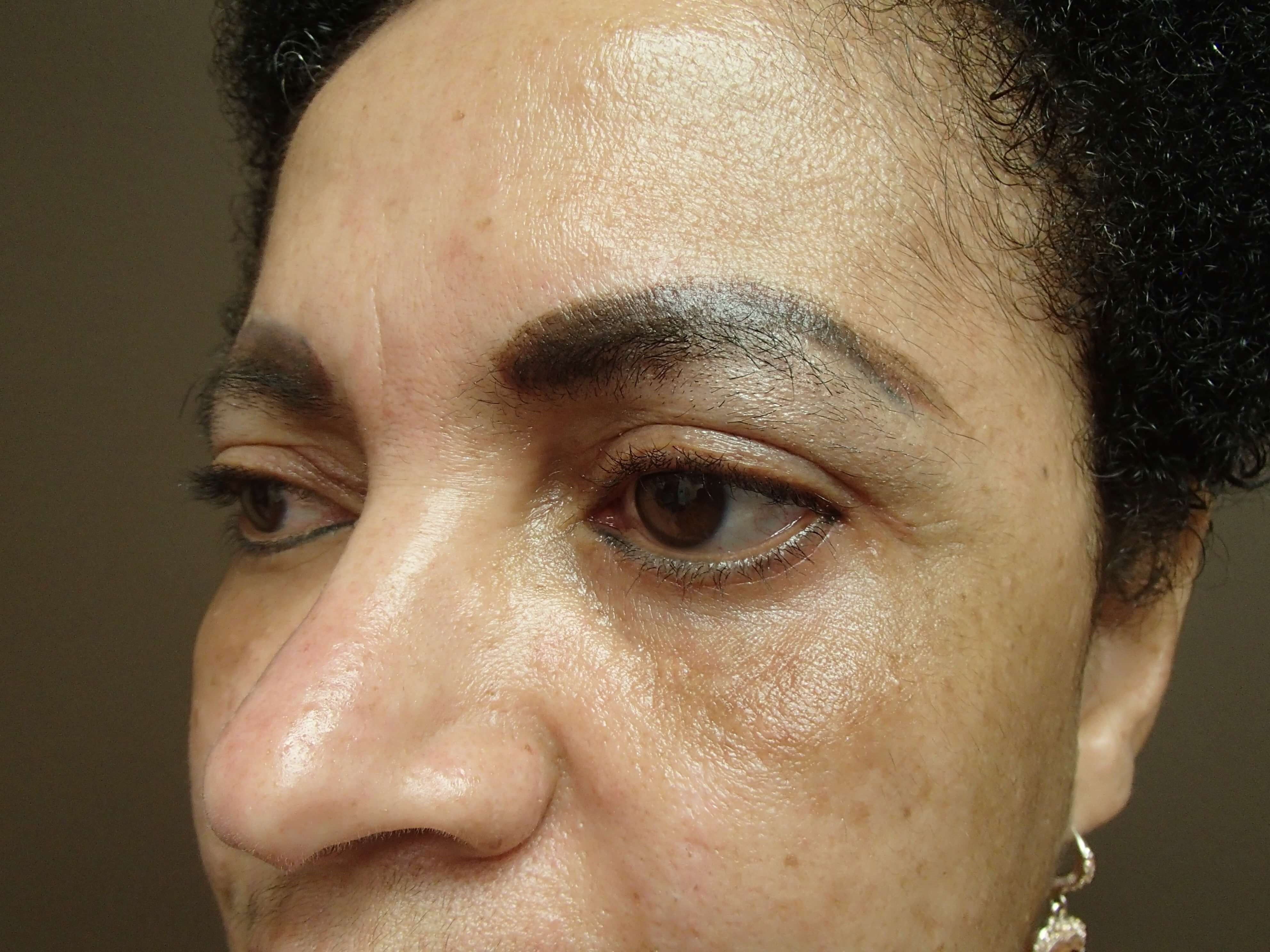 Browlift w/ Eyelid Lift After