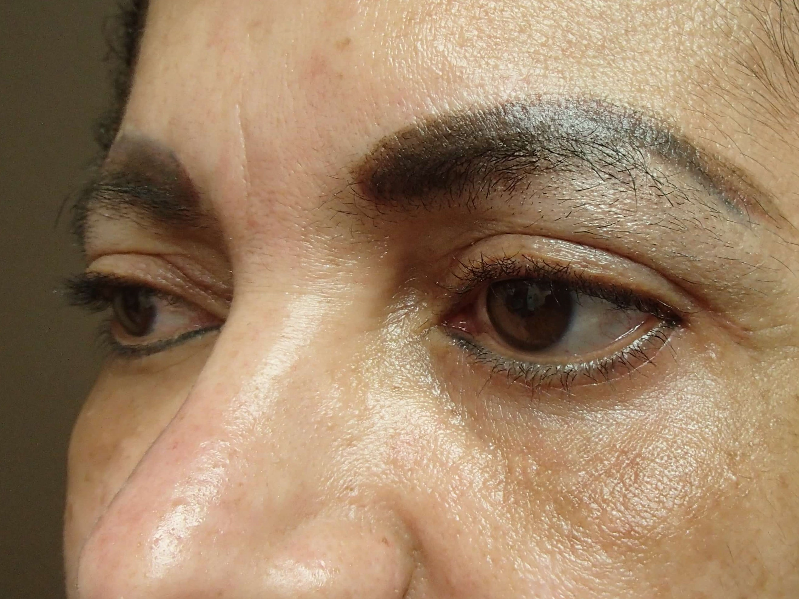 Blepharoplasty After