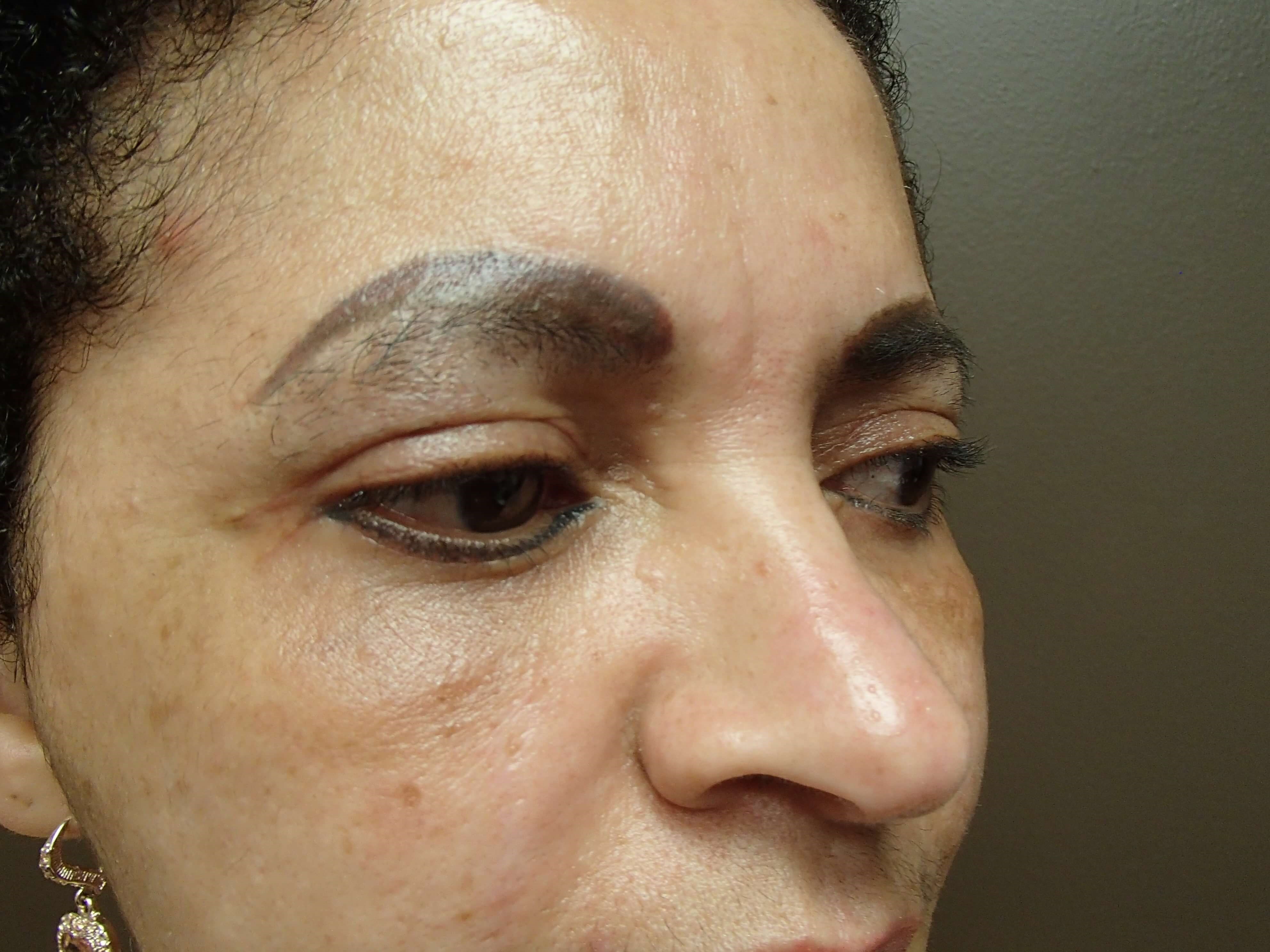 Browlift w/ Eyelid Lift After