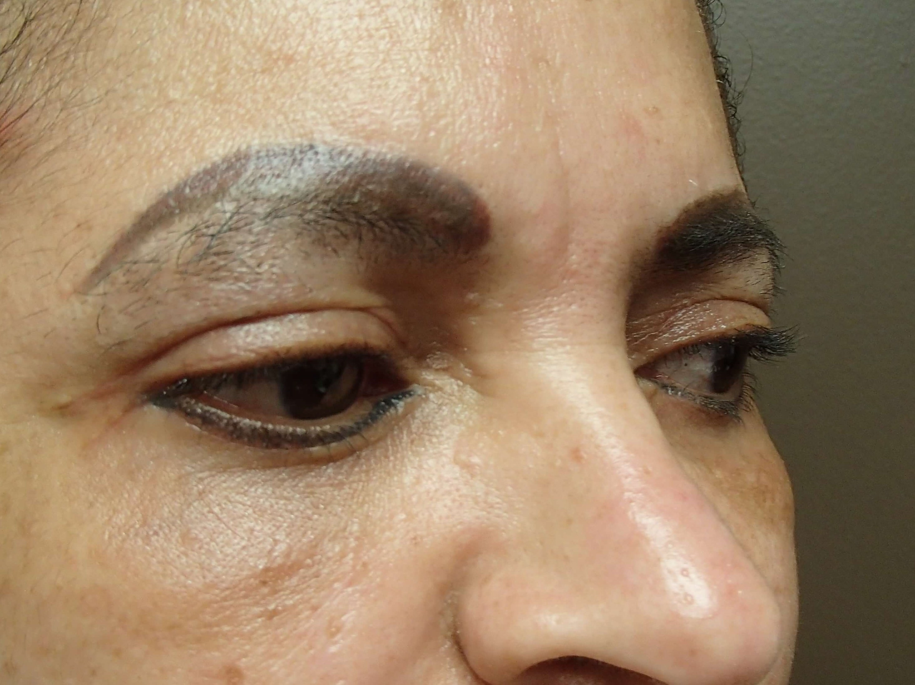 Blepharoplasty After