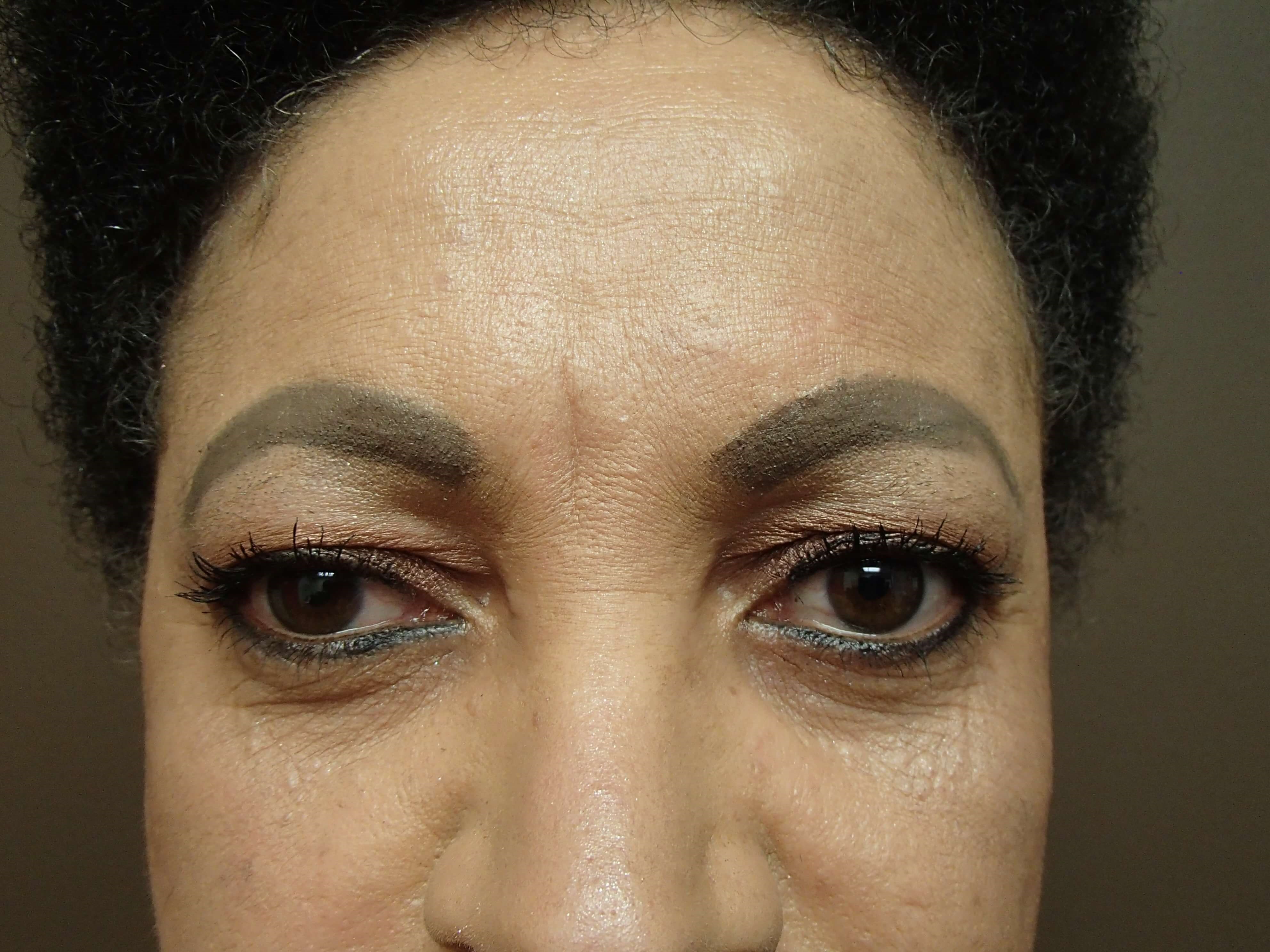 Blepharoplasty Before