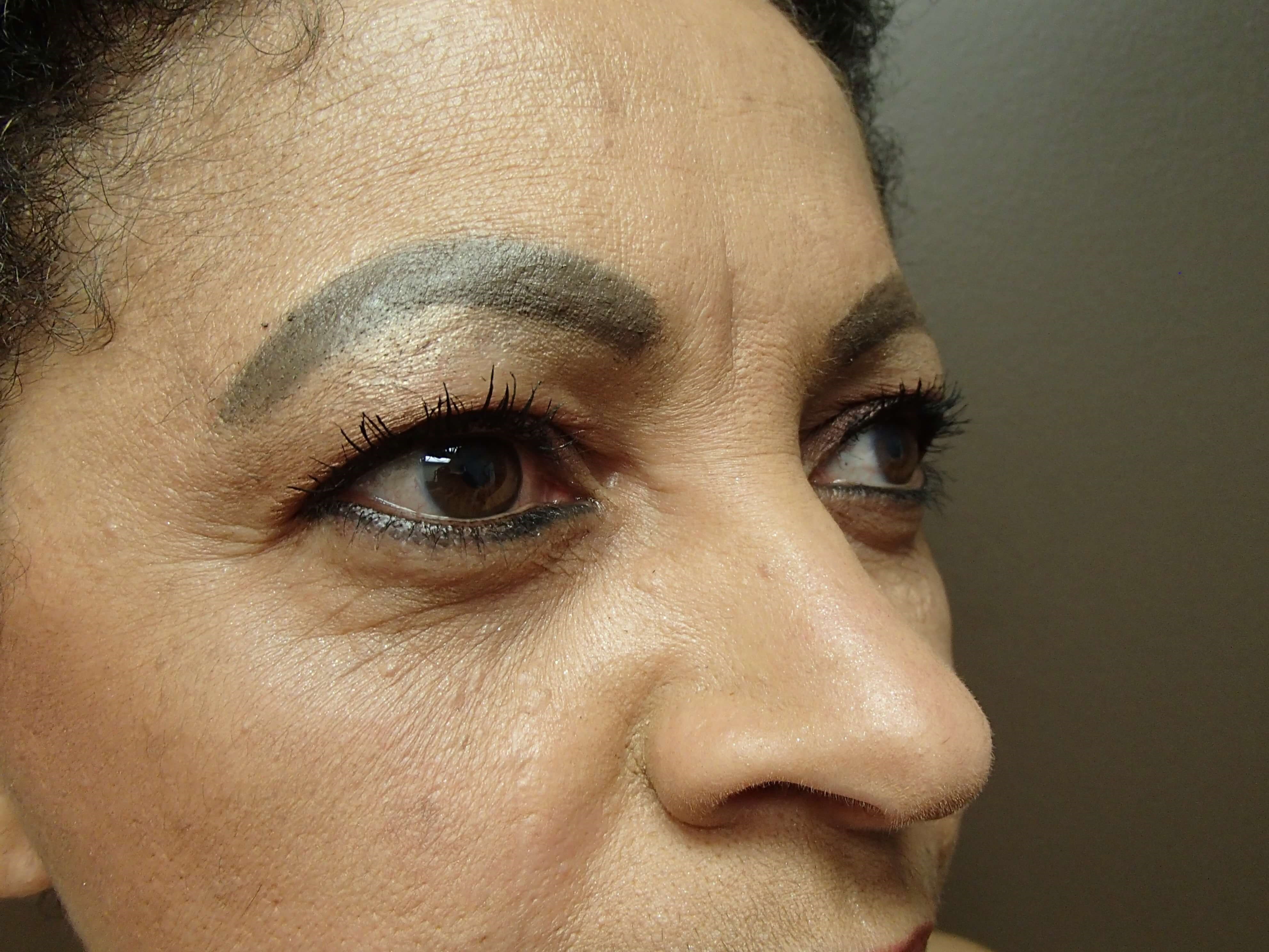 Browlift w/ Eyelid Lift Before