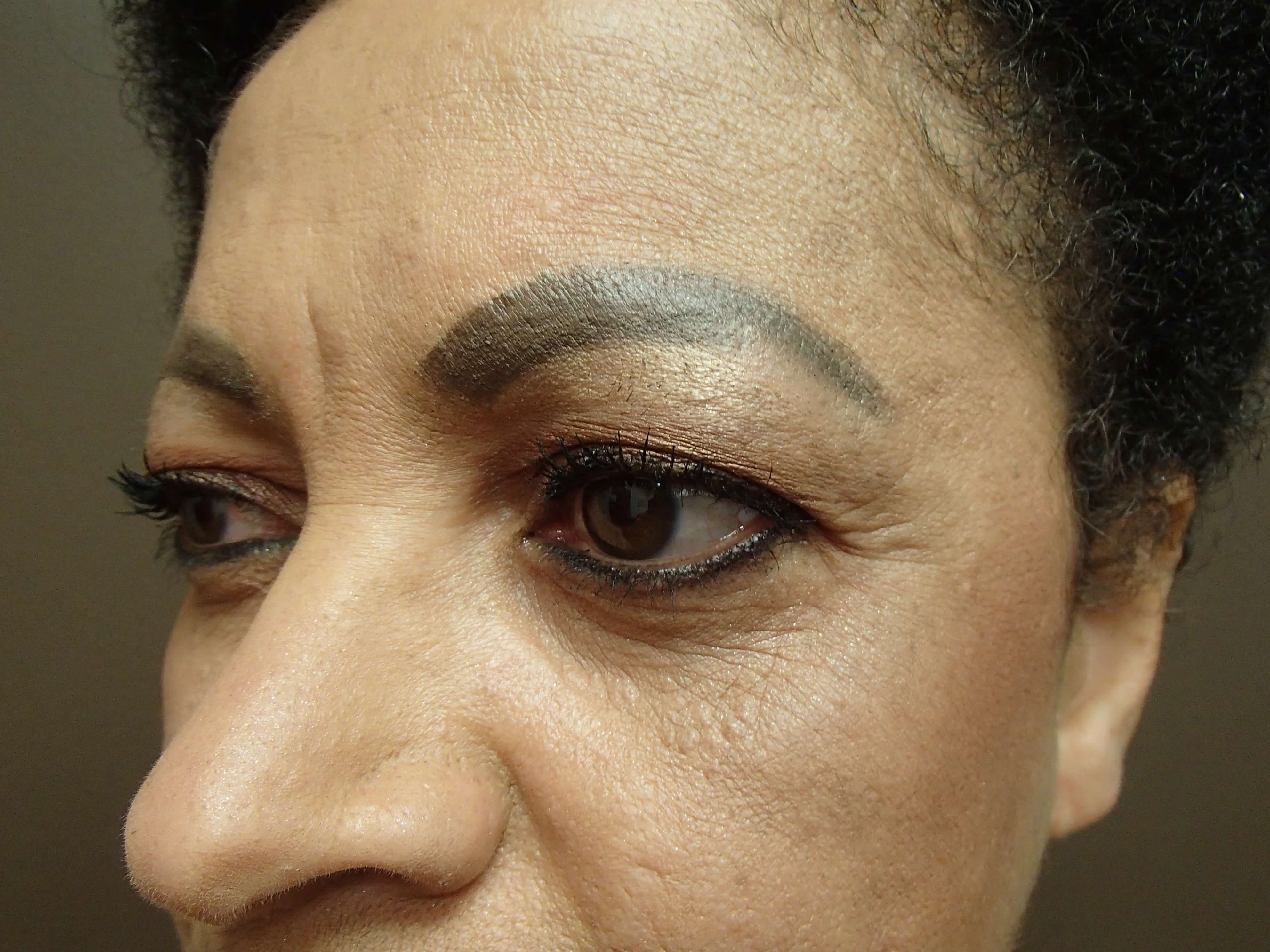 Browlift w/ Eyelid Lift Before