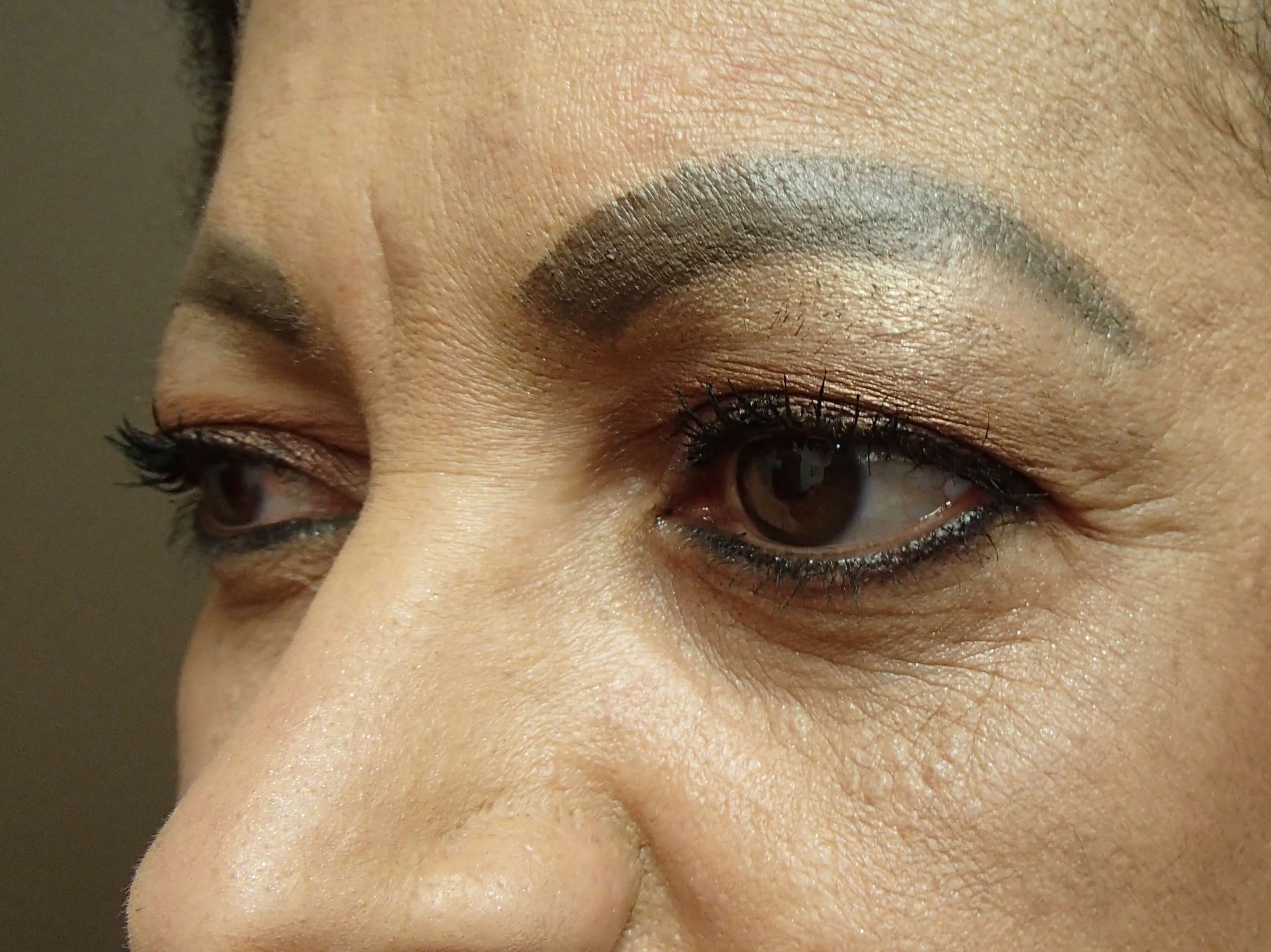 Blepharoplasty Before