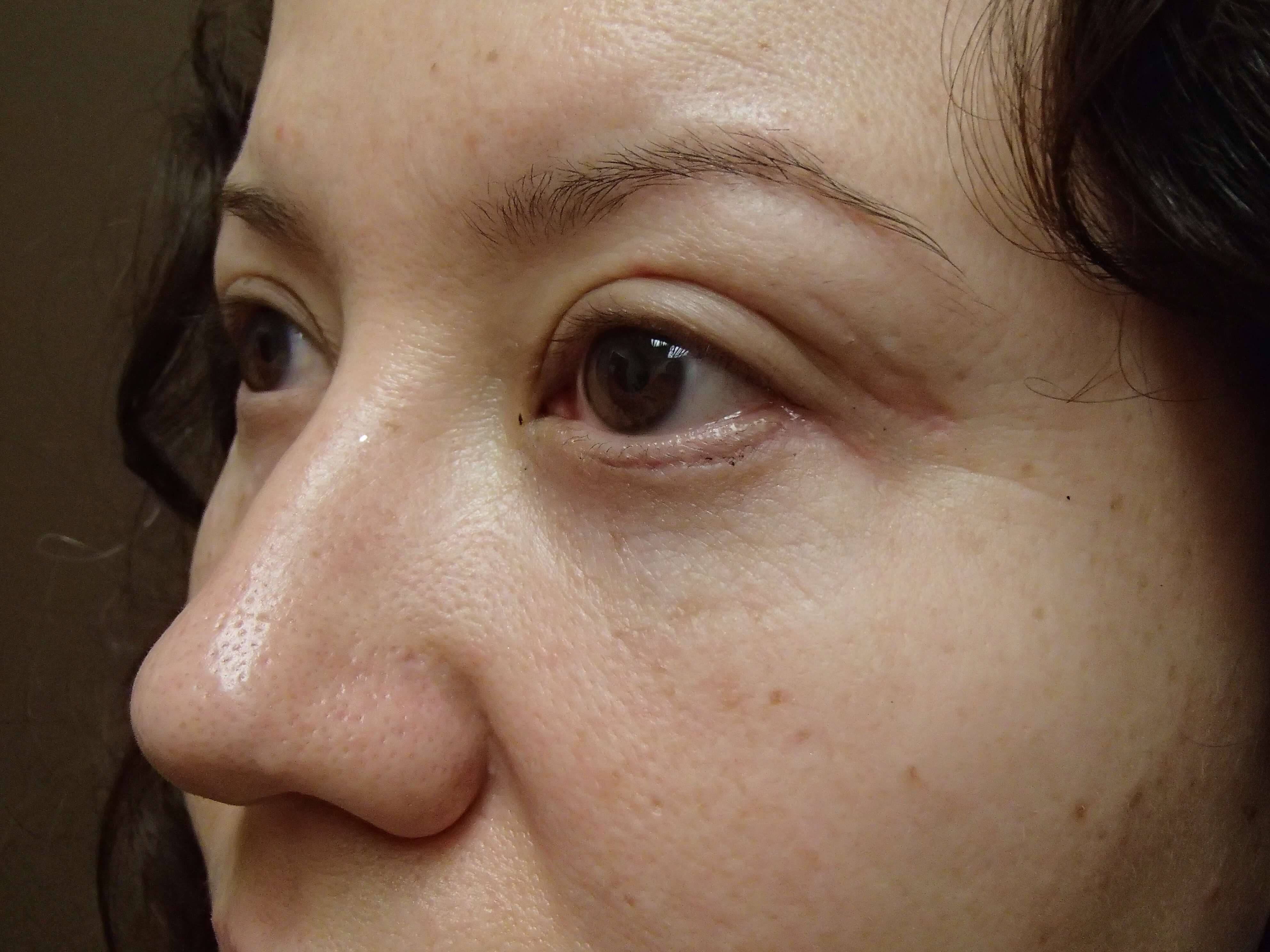 Browlift w/ Eyelid Lift After