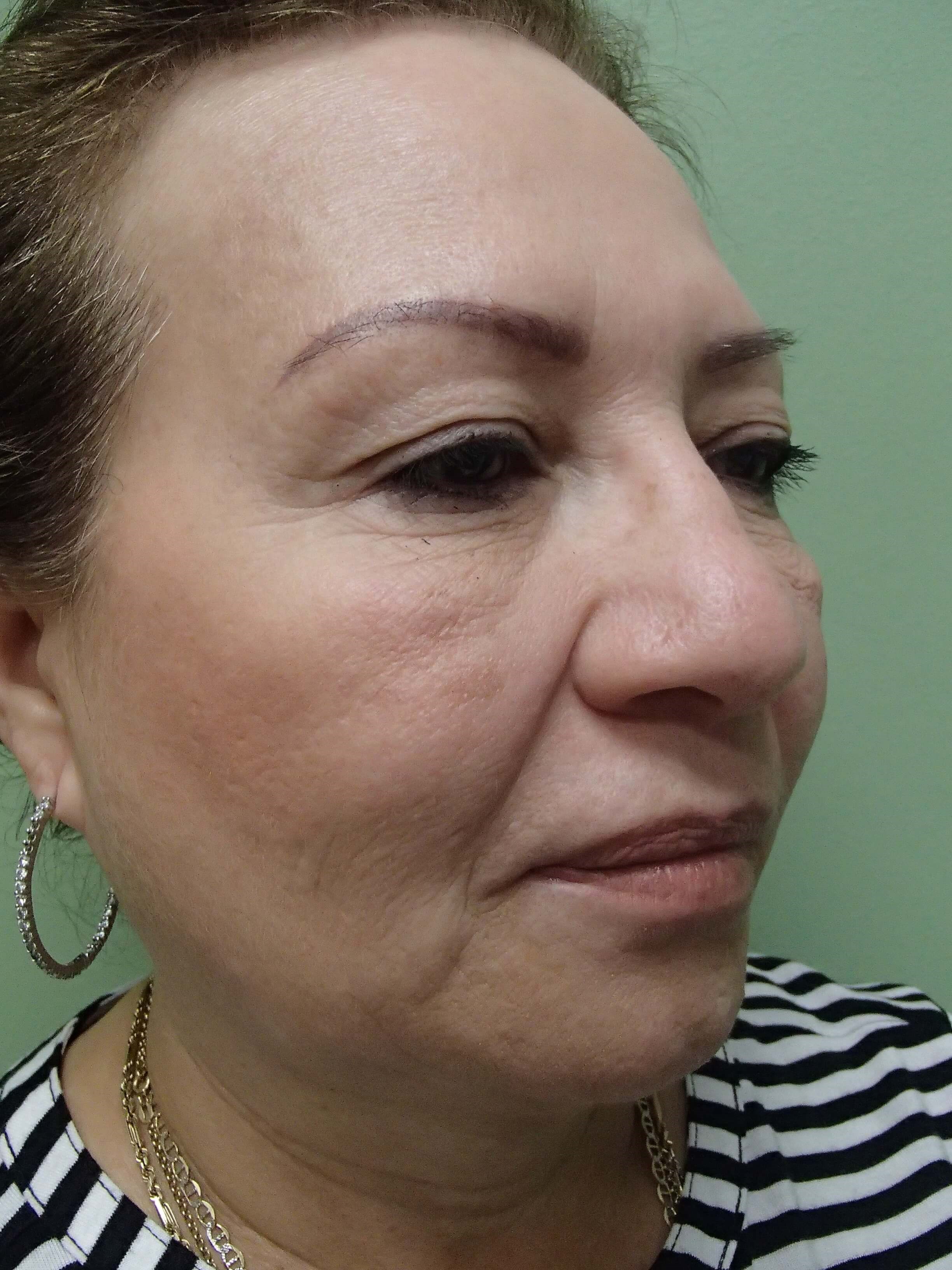 Browlift w/ Eyelid Lift Before