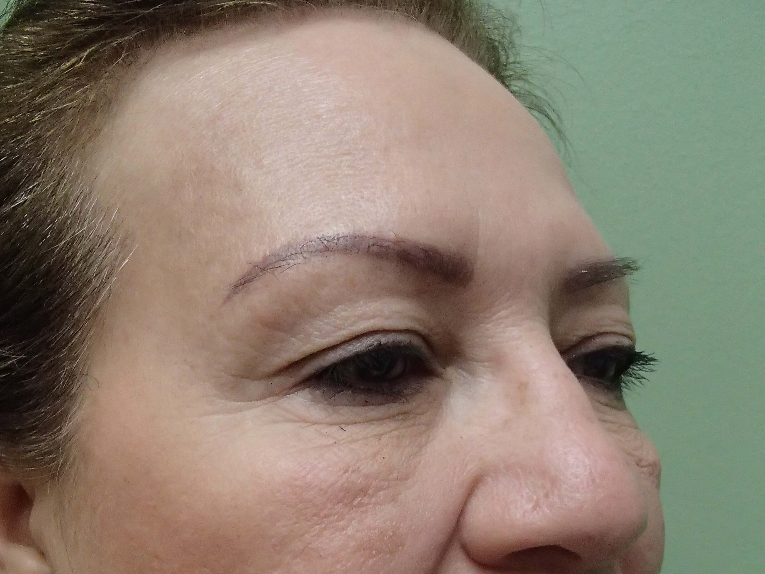 Browlift w/ Eyelid Lift Before