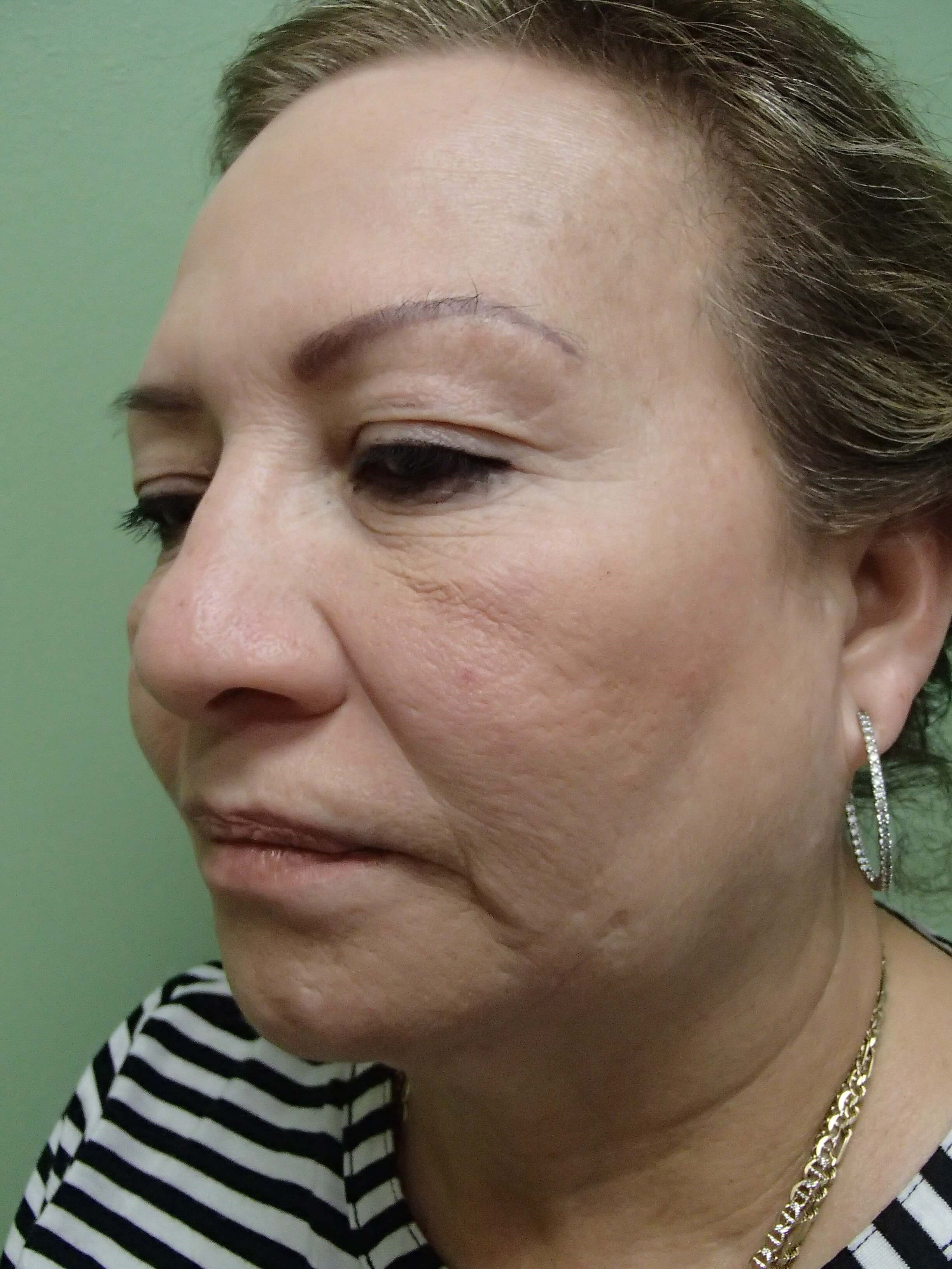 Browlift w/ Eyelid Lift Before