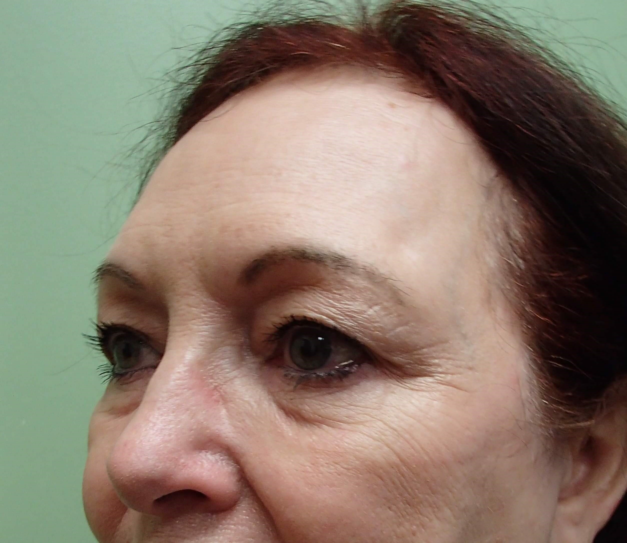 Browlift w/ Eyelid Lift Before
