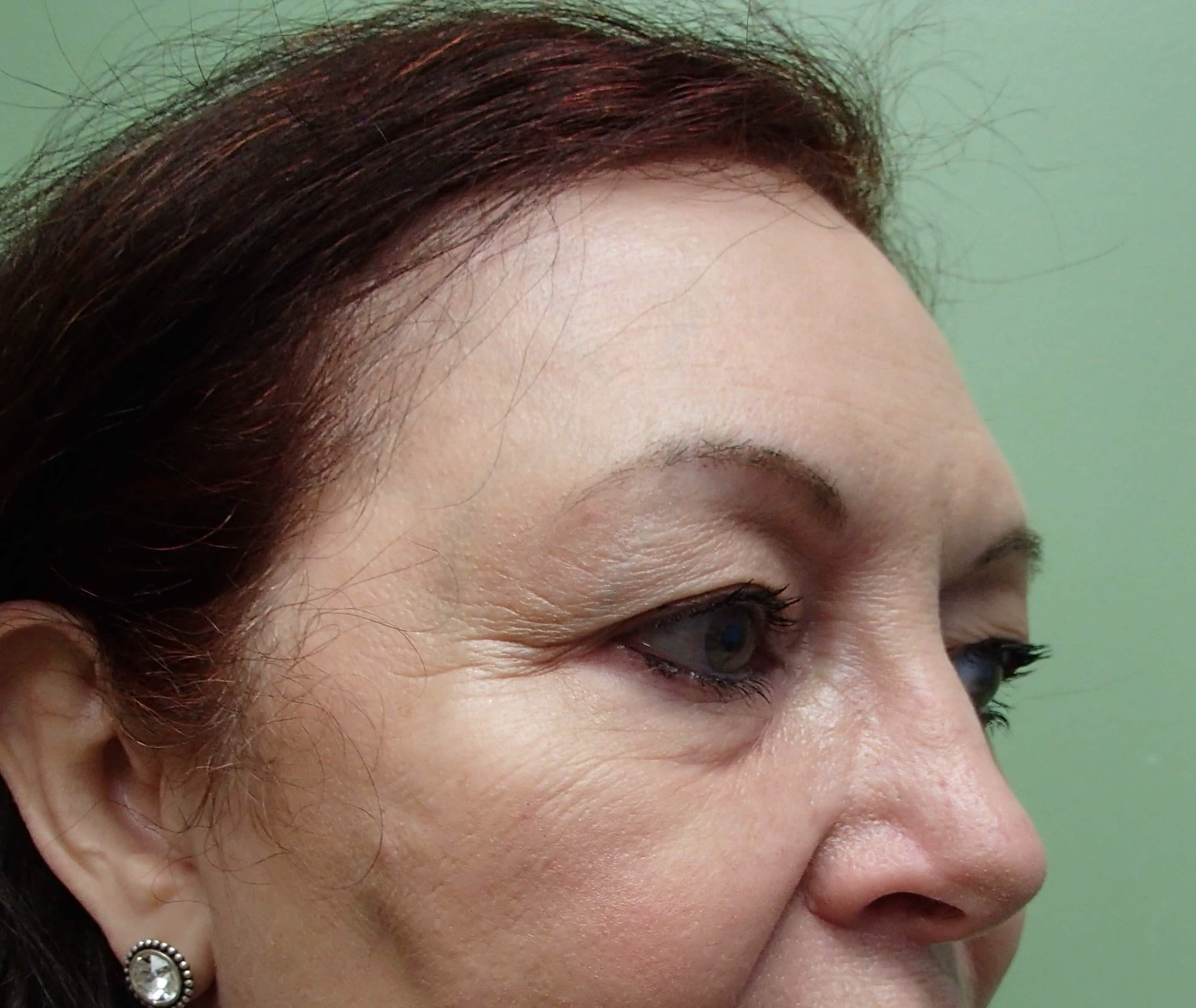 Browlift w/ Eyelid Lift Before