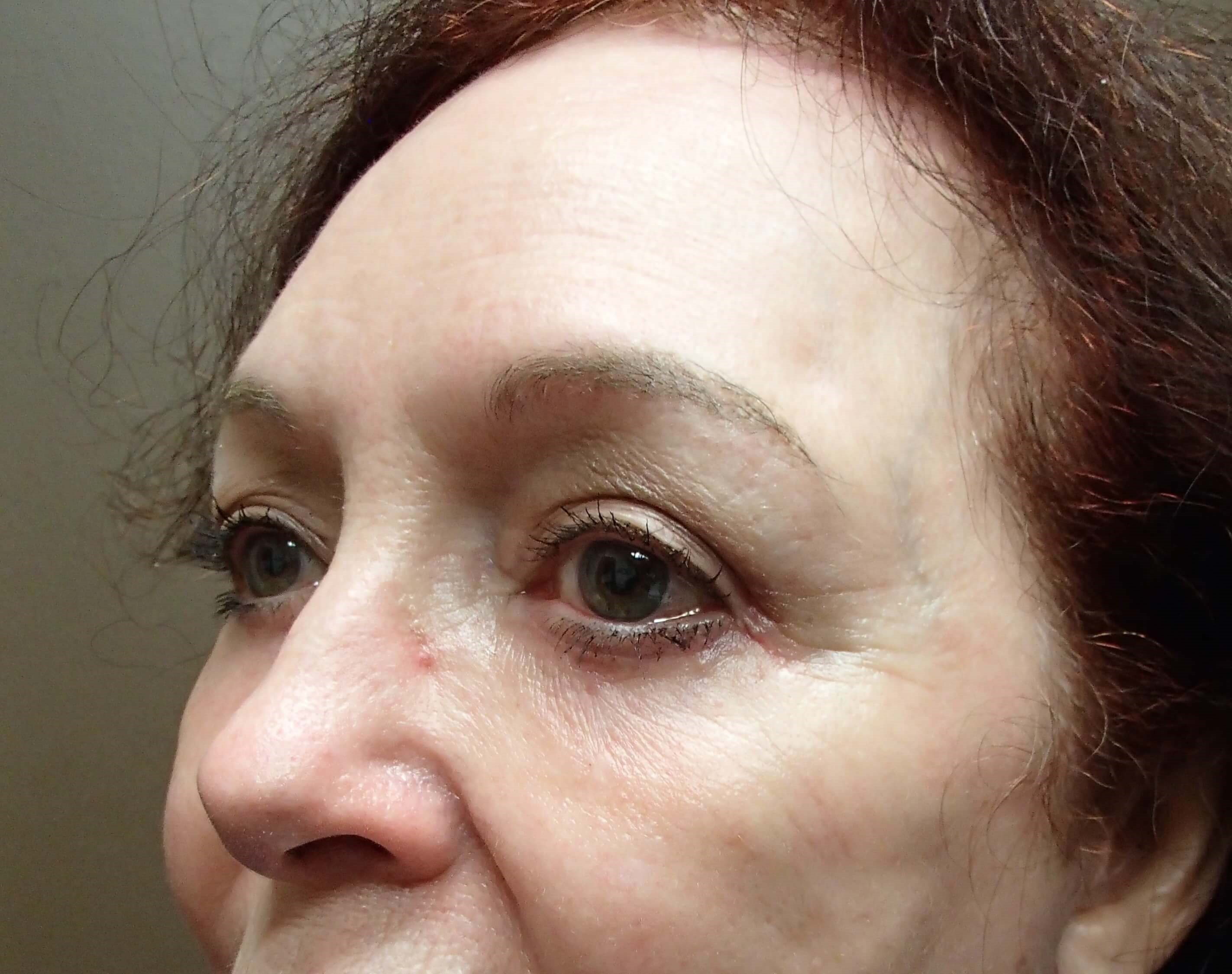 Browlift w/ Eyelid Lift After