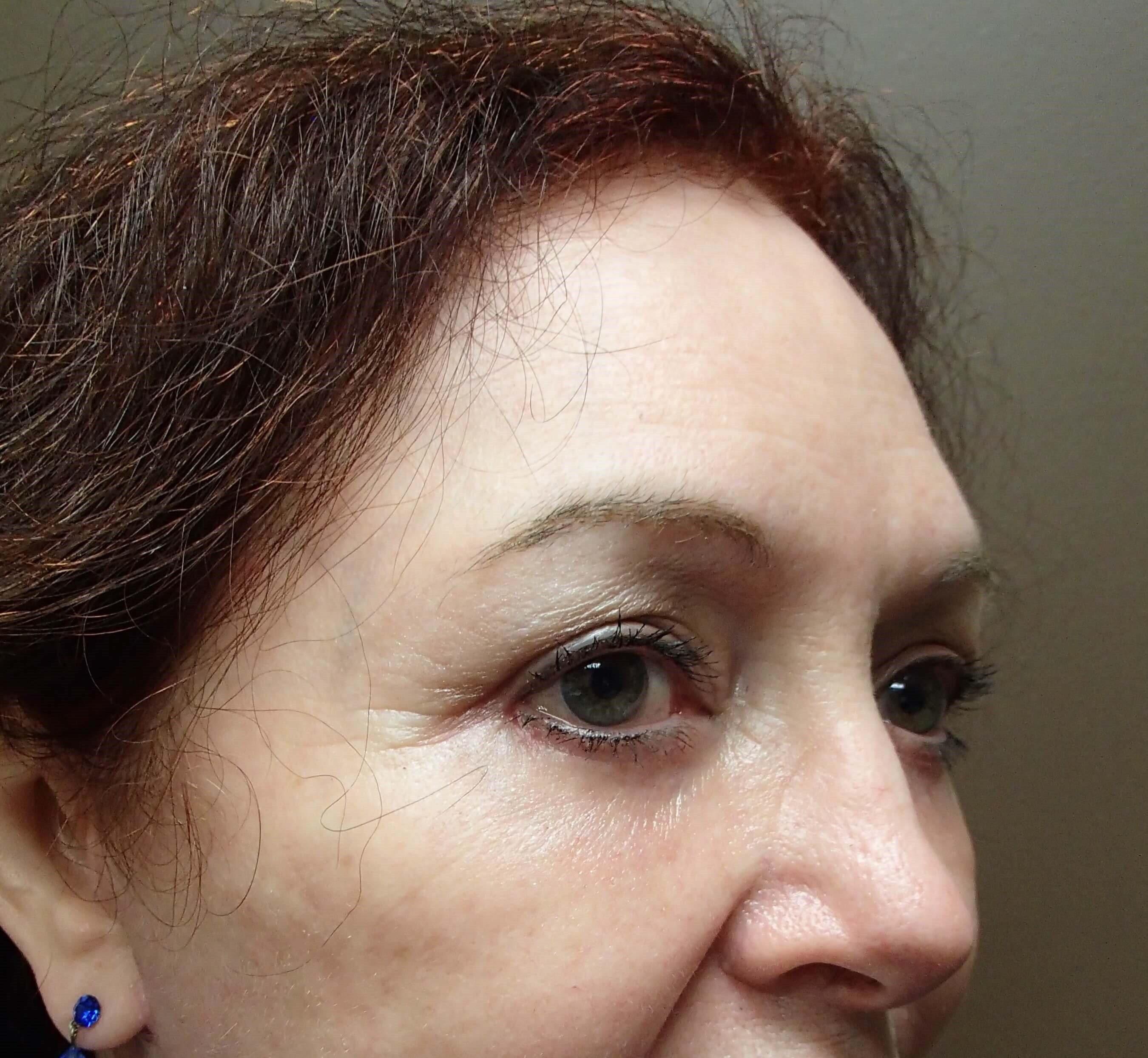 Browlift w/ Eyelid Lift After