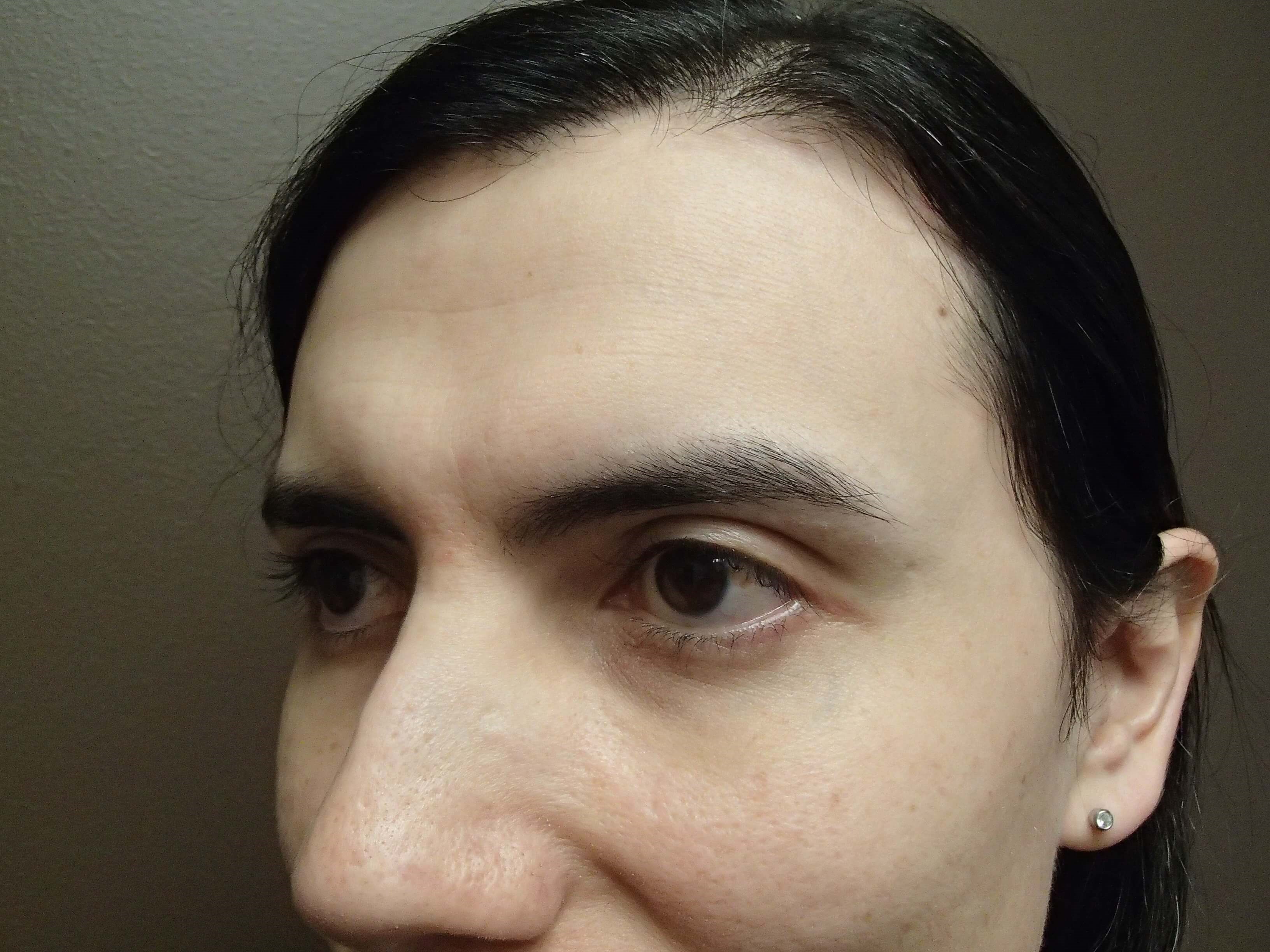 Browlift Before