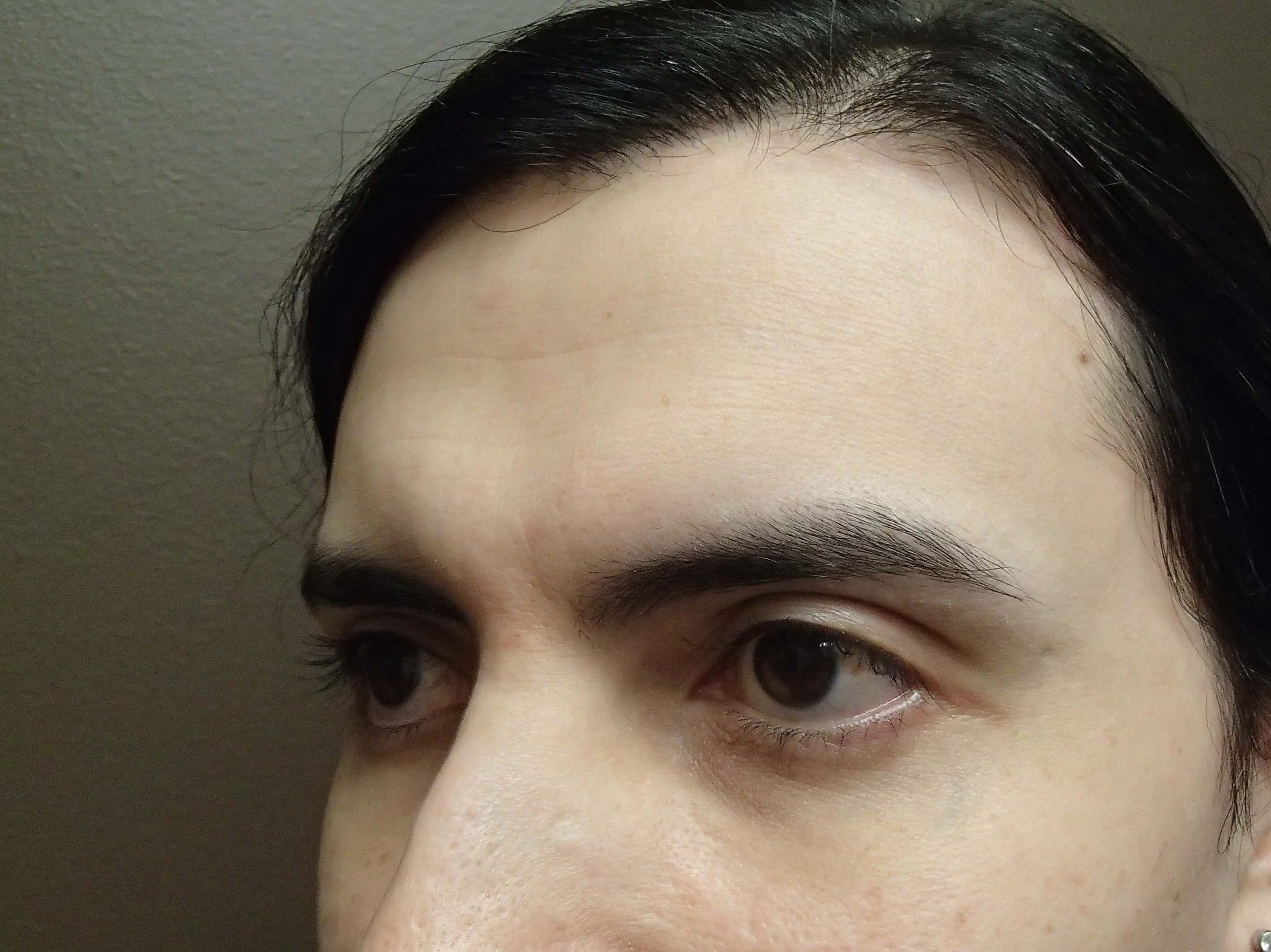 Browlift Before