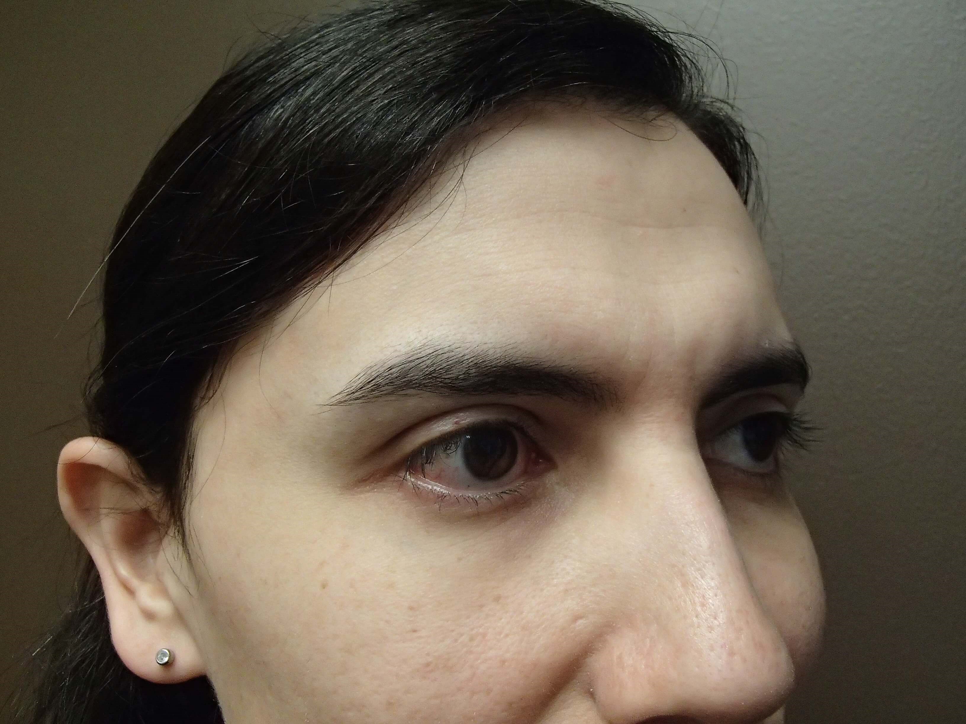 Browlift Before
