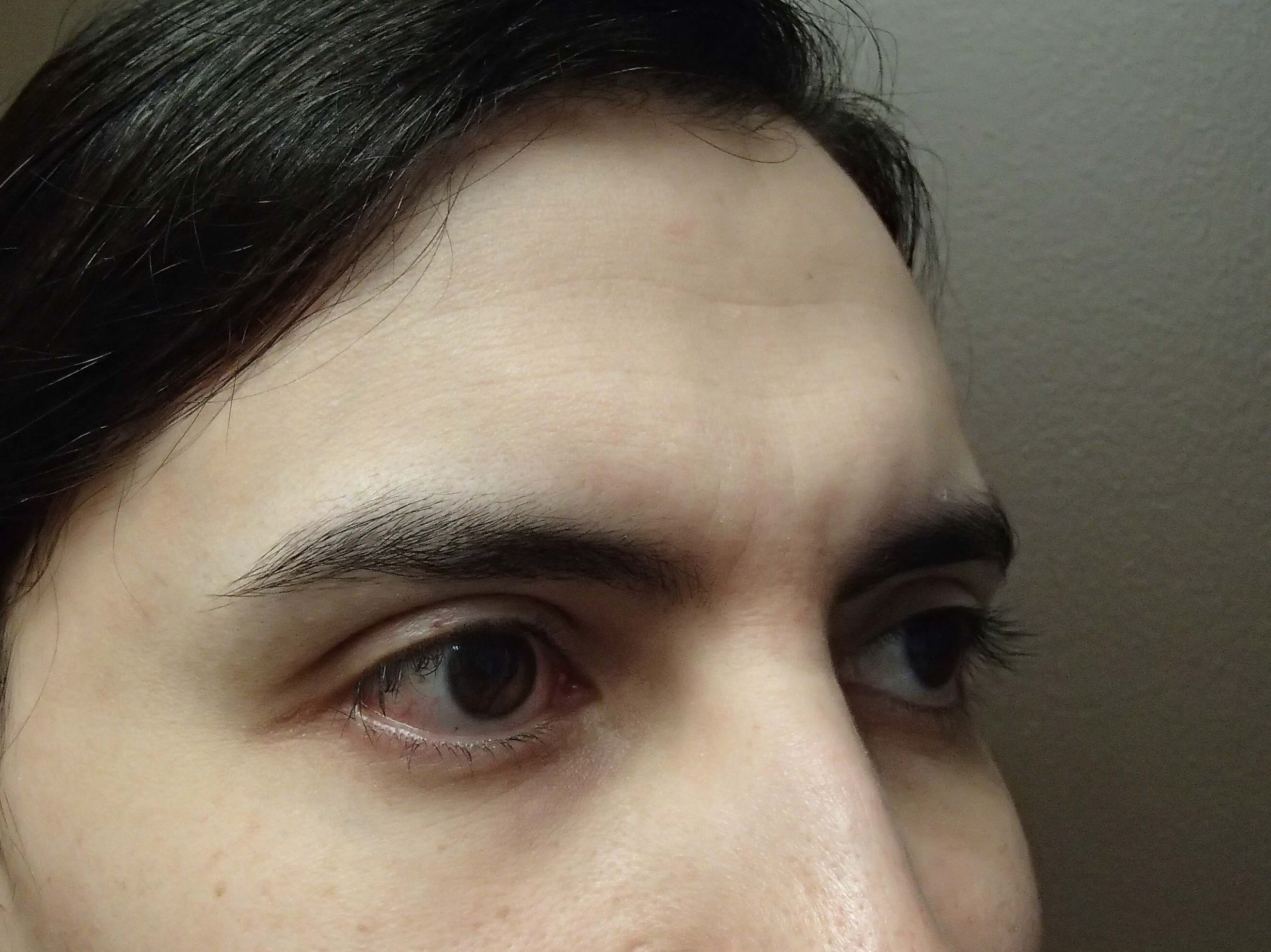 Browlift Before