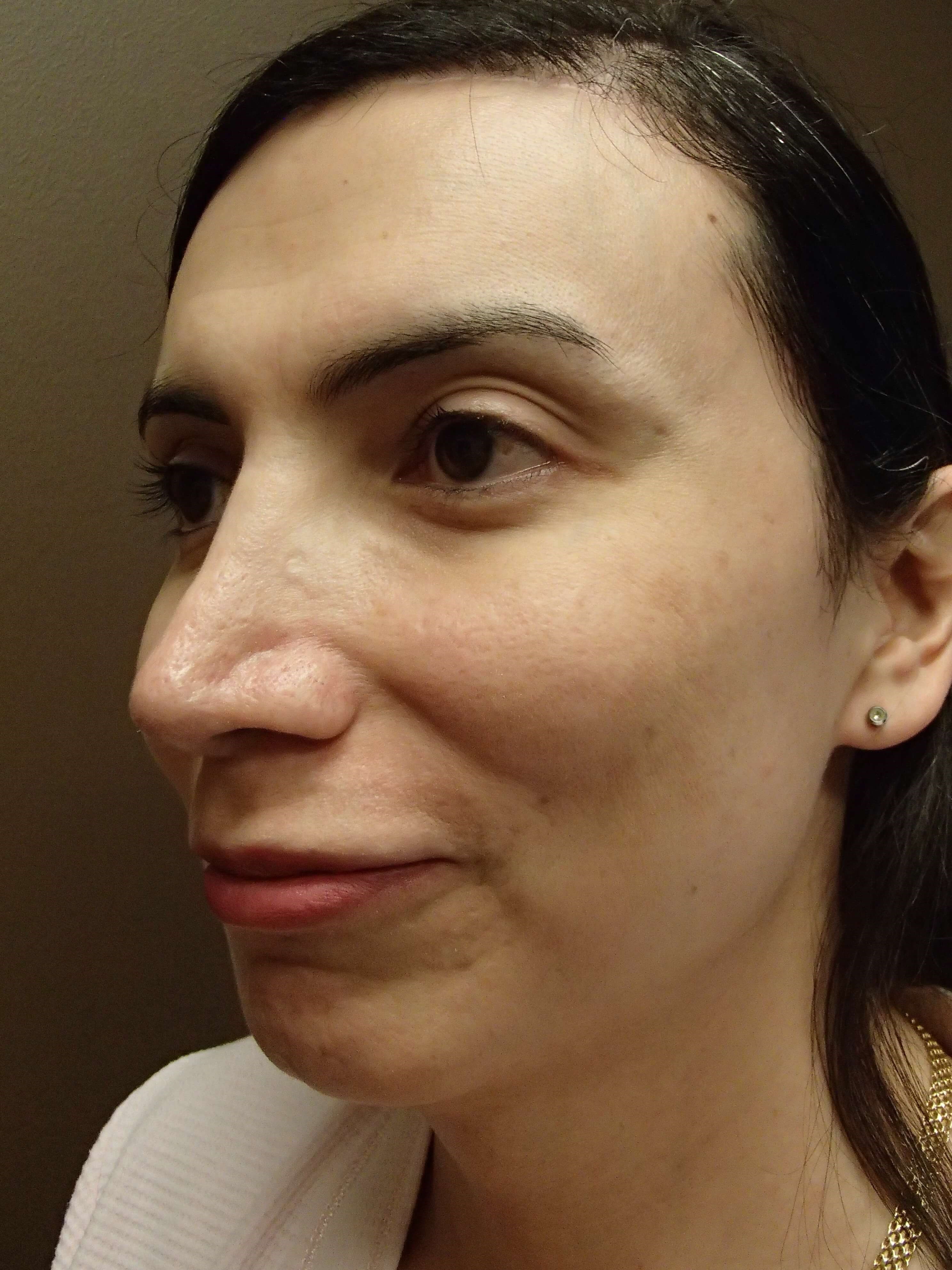Browlift After