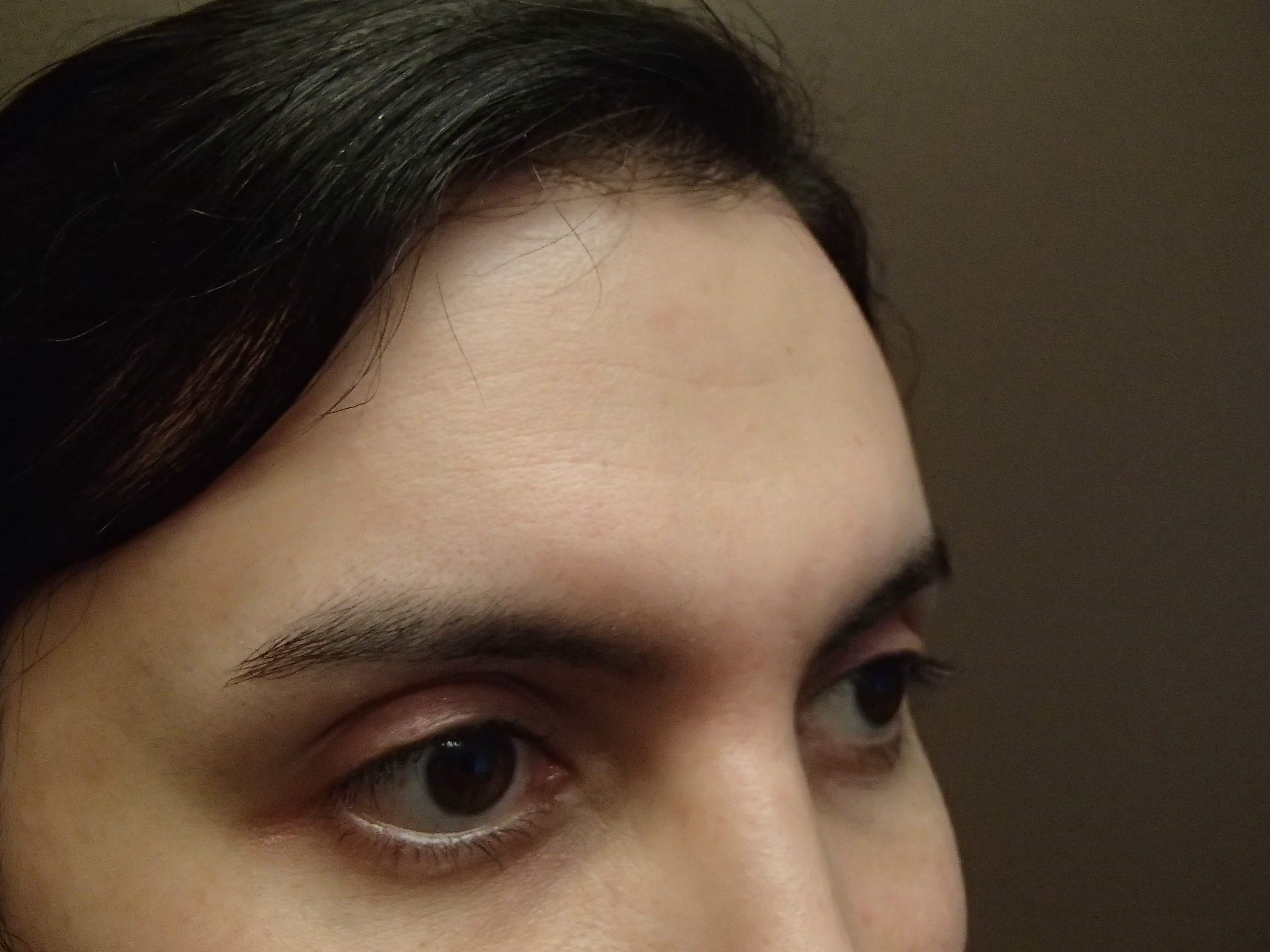 Browlift After