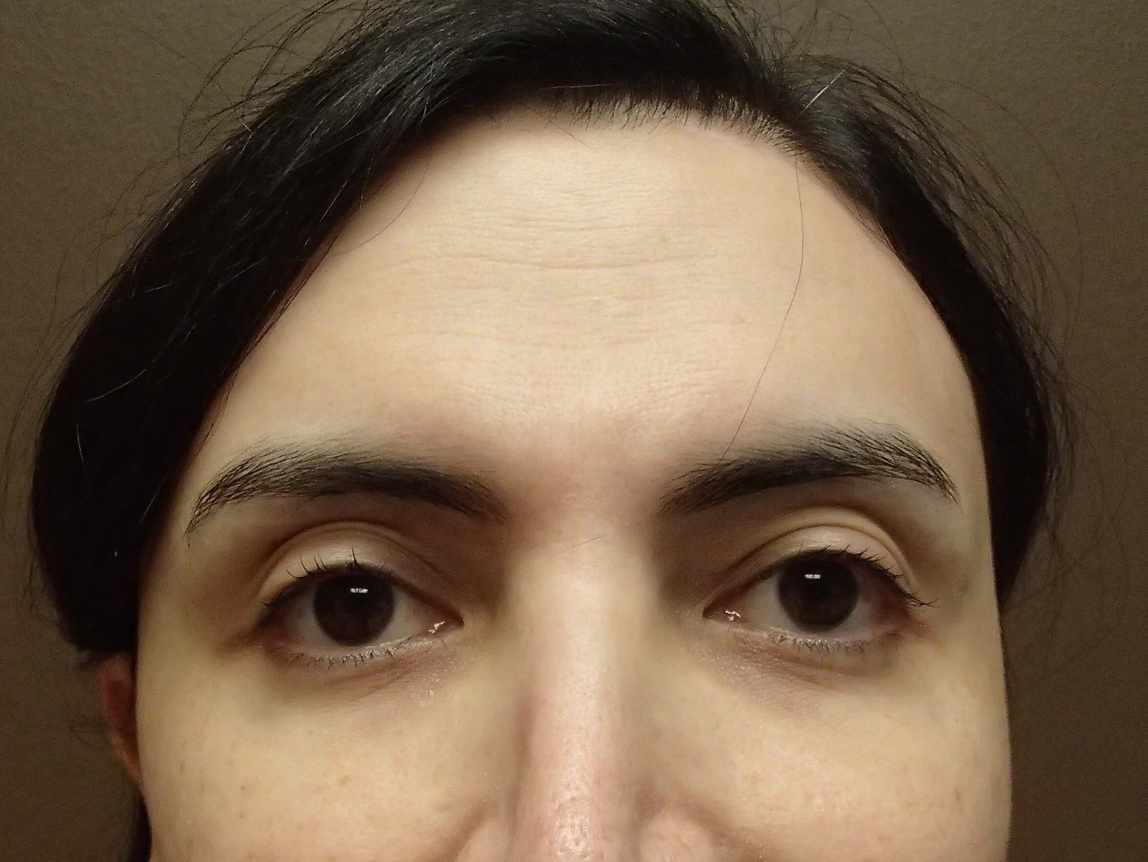 Browlift After