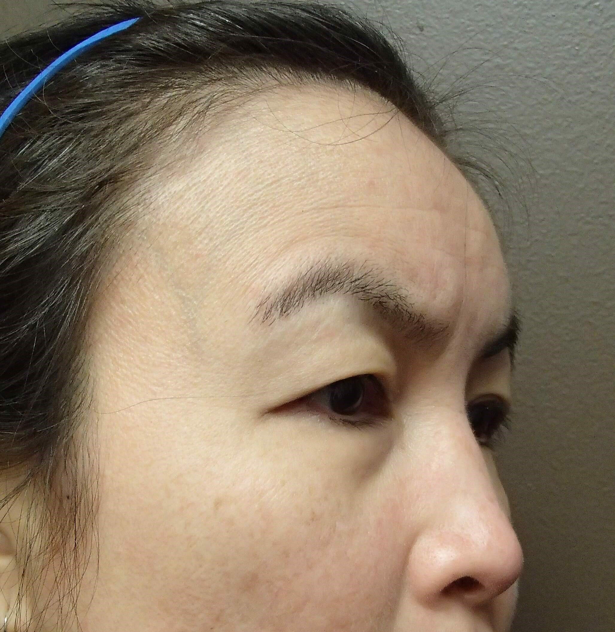 Browlift w/ Eyelid Lift Before