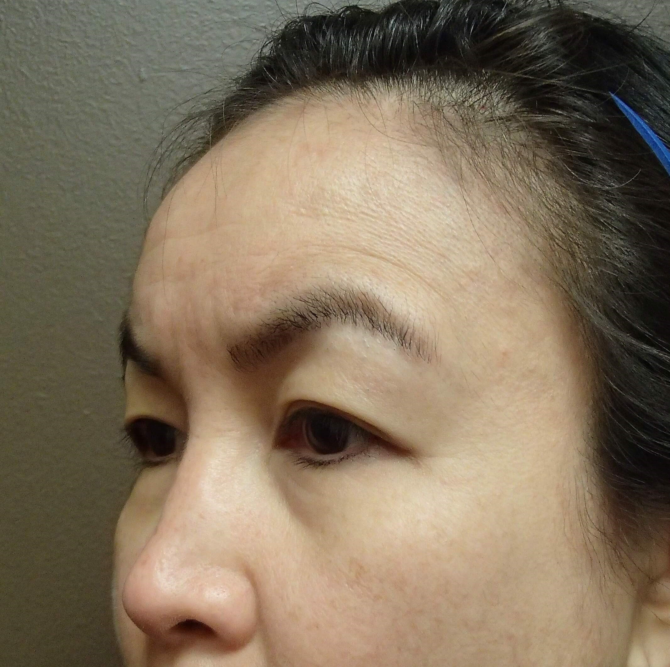 Browlift w/ Eyelid Lift Before