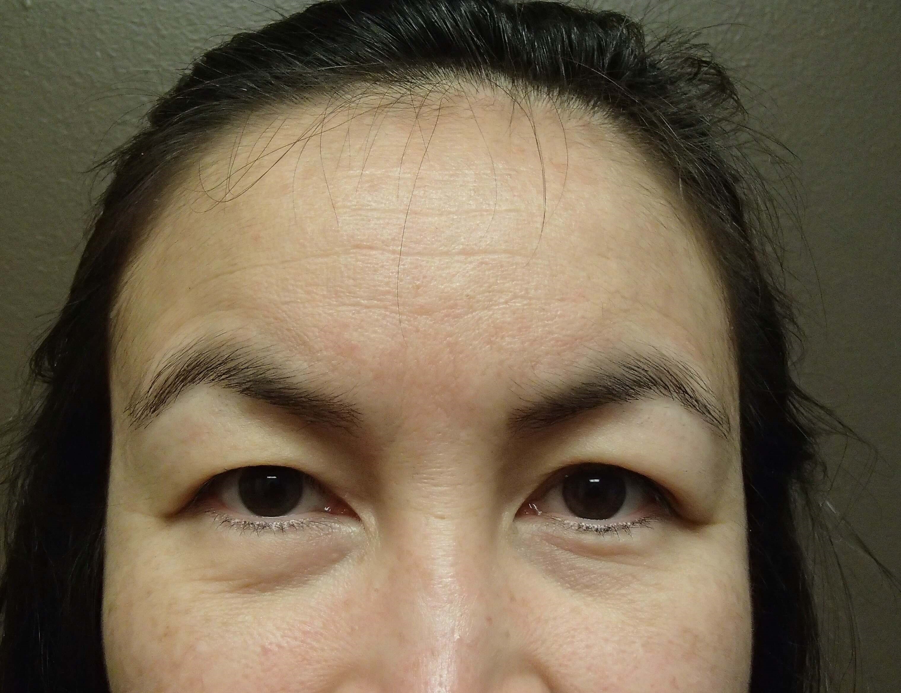 Browlift w/ Eyelid Lift Before