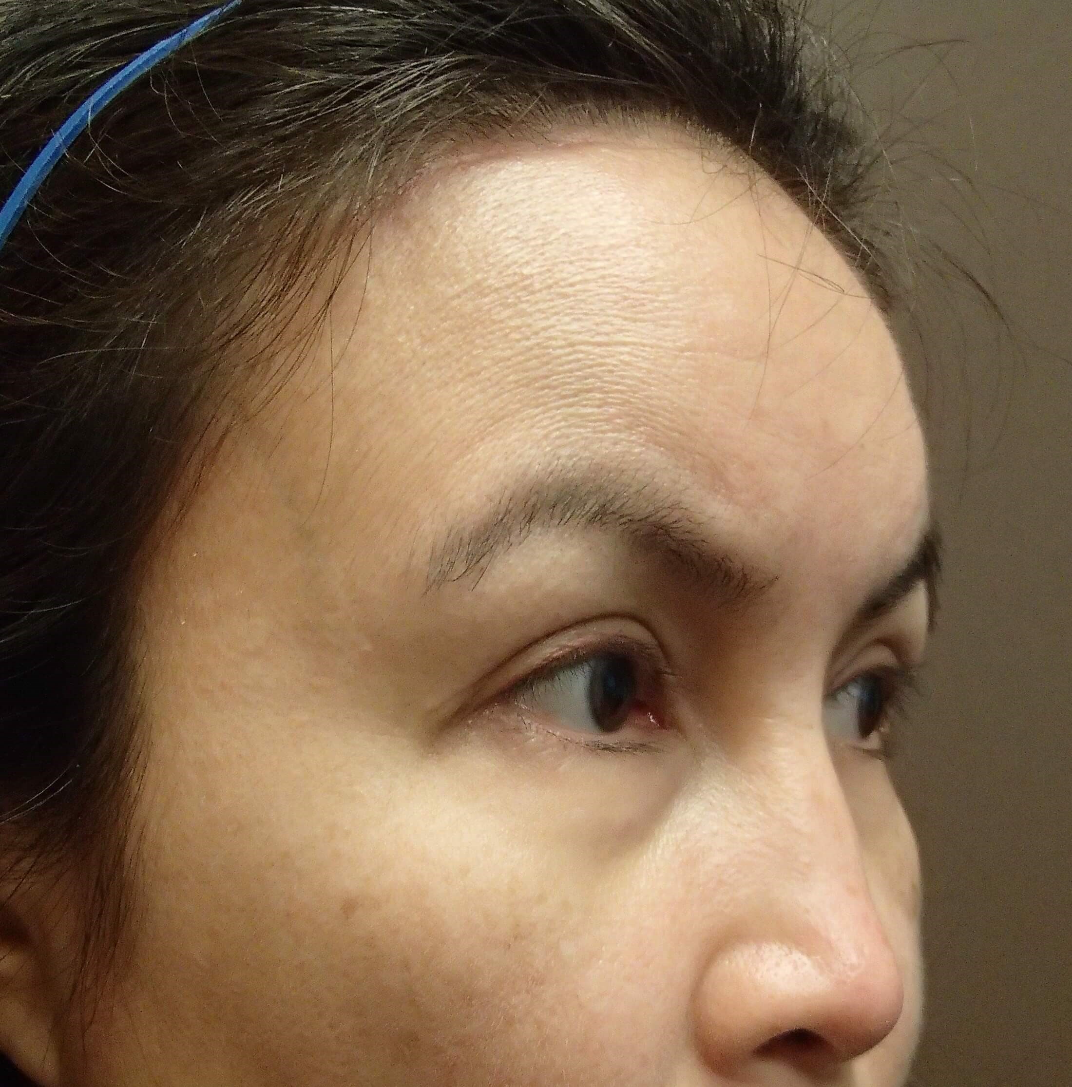 Browlift w/ Eyelid Lift After