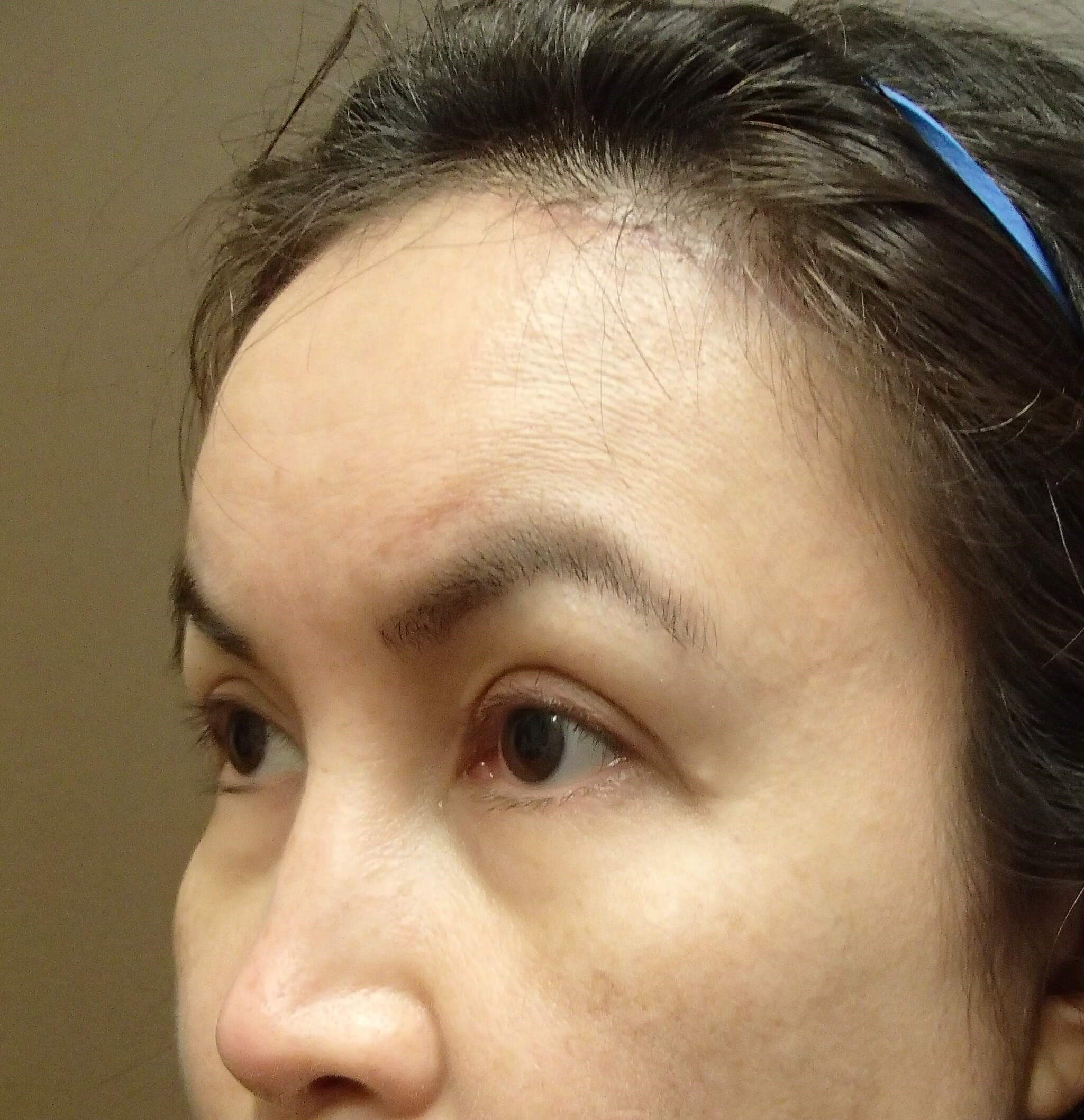 Browlift w/ Eyelid Lift After