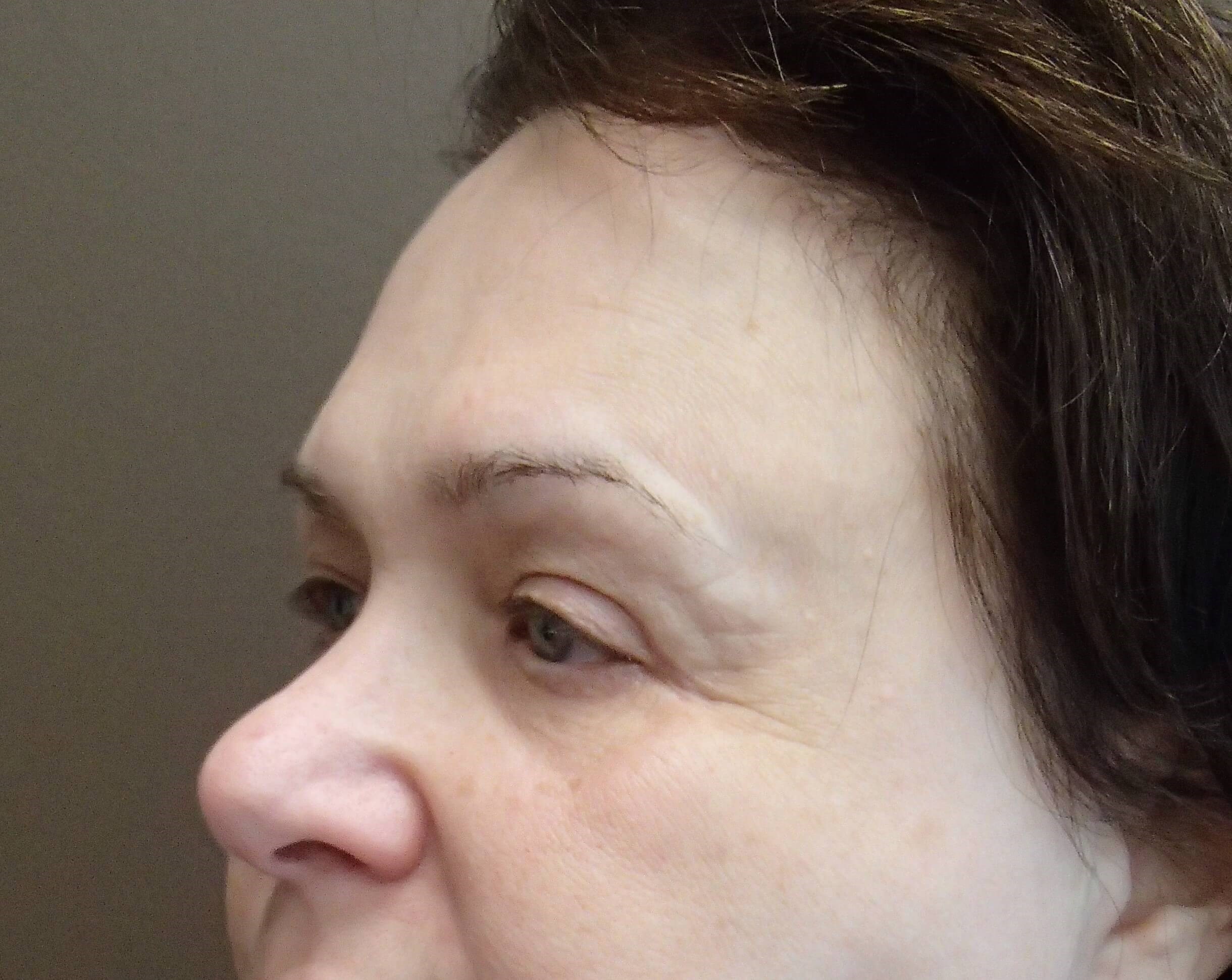 Browlift w/ Eyelid Lift After