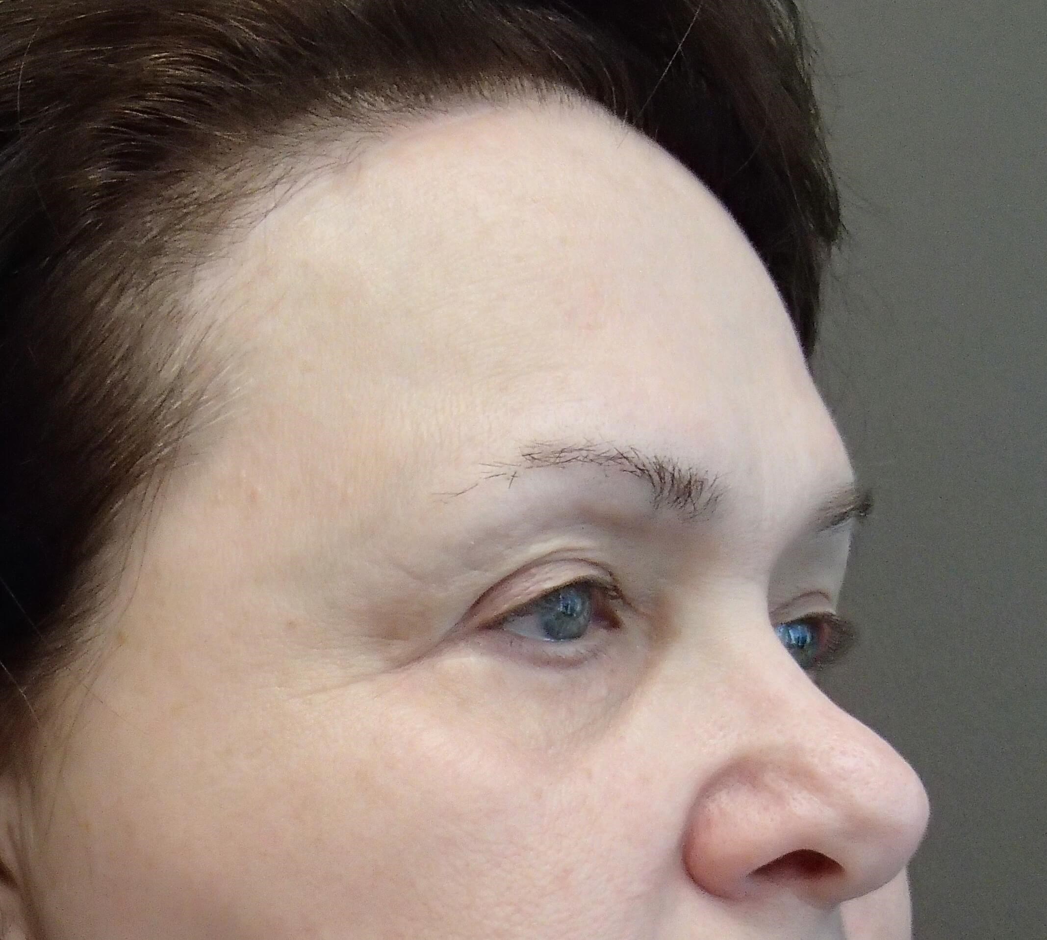 Browlift w/ Eyelid Lift After