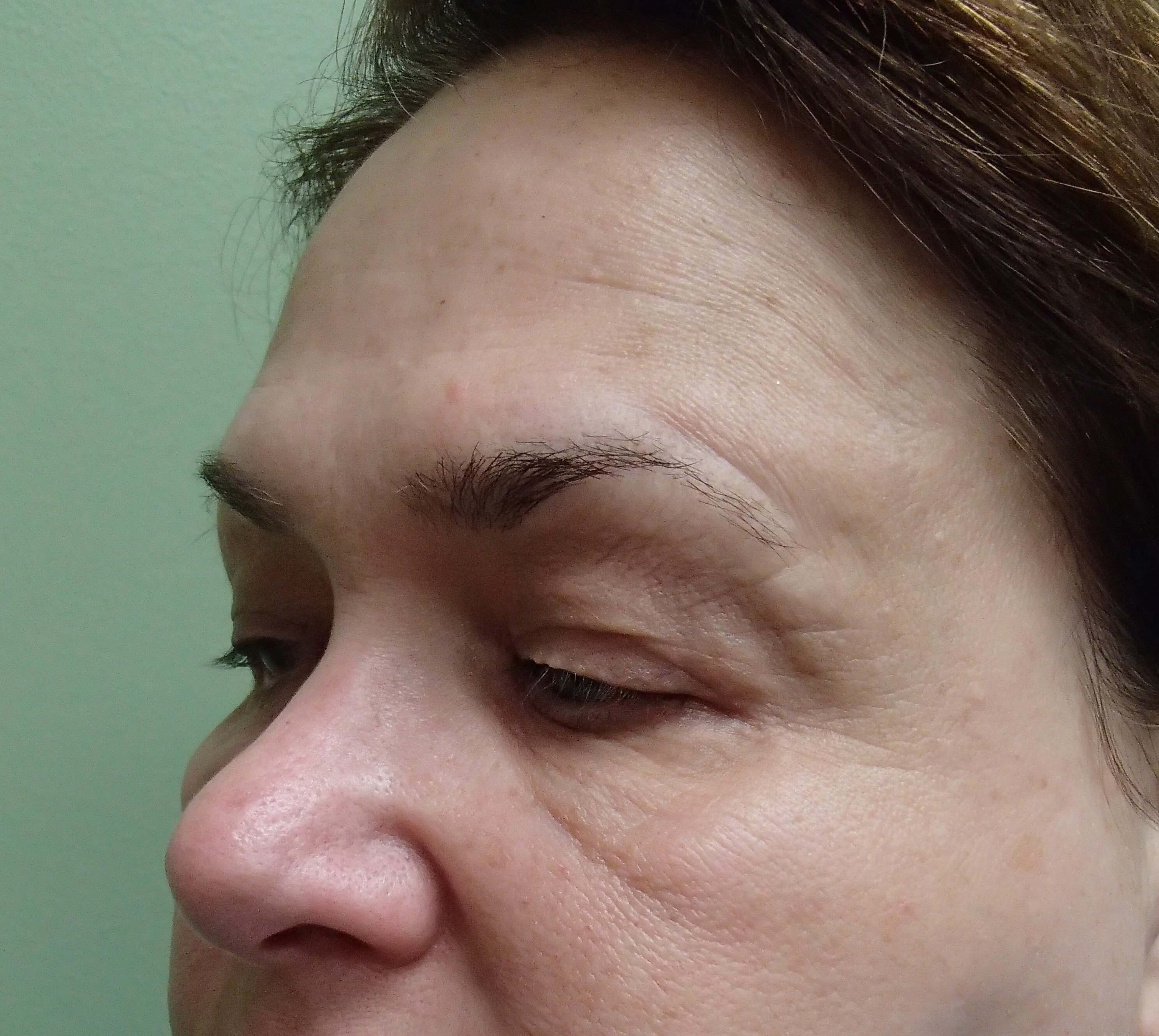 Browlift w/ Eyelid Lift Before