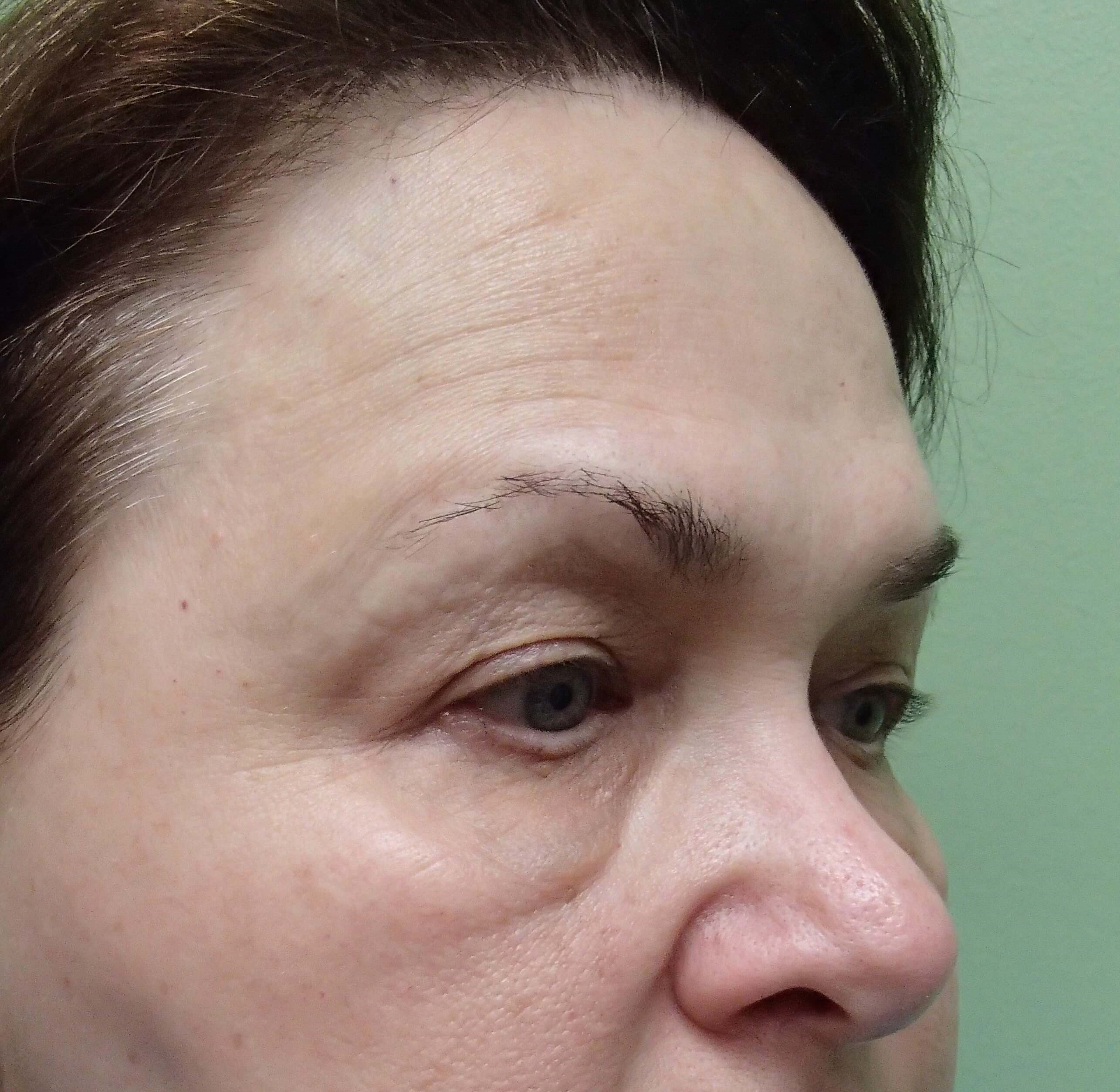 Browlift w/ Eyelid Lift Before