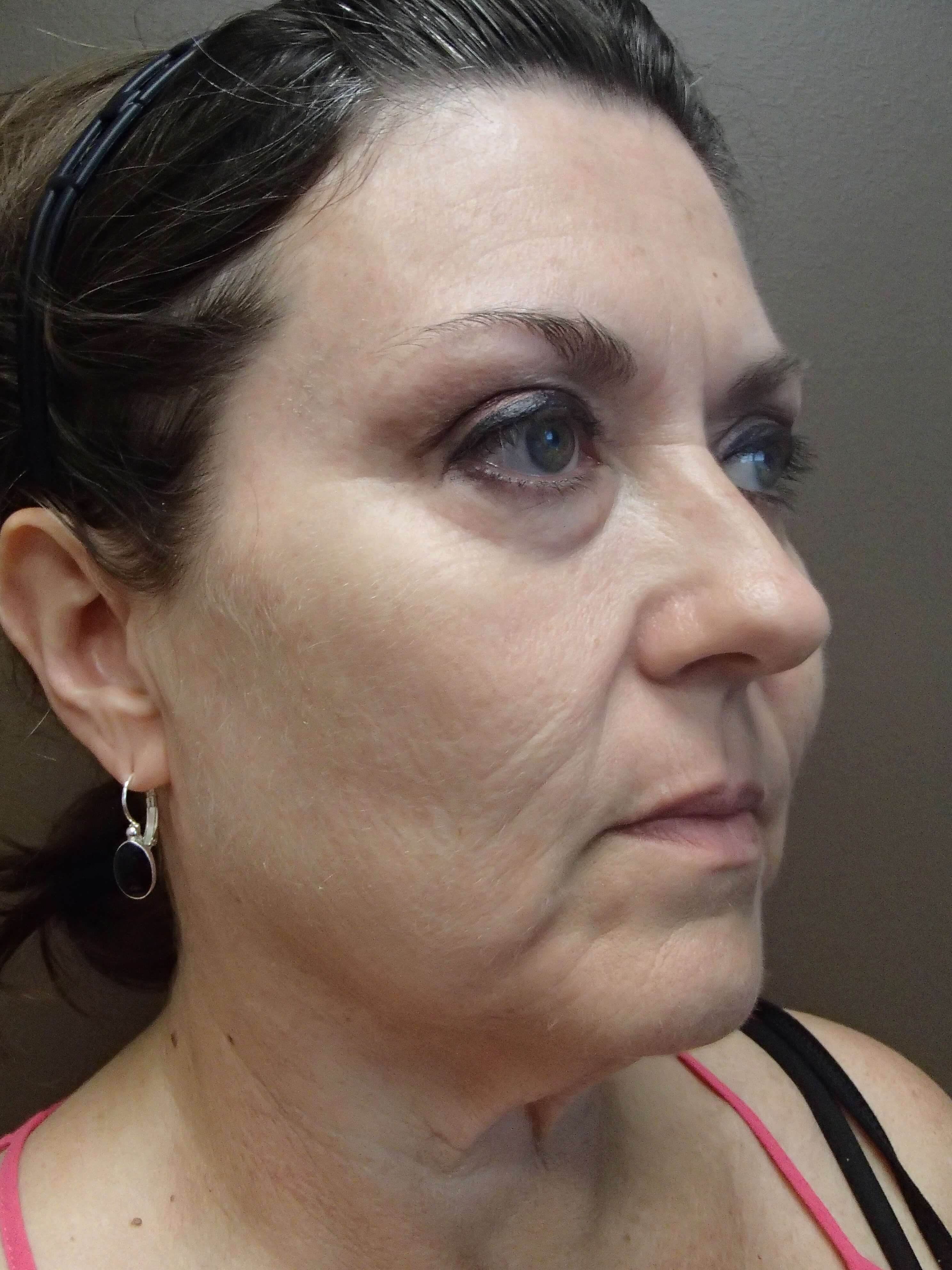 Browlift w/ Eyelid Lift Before