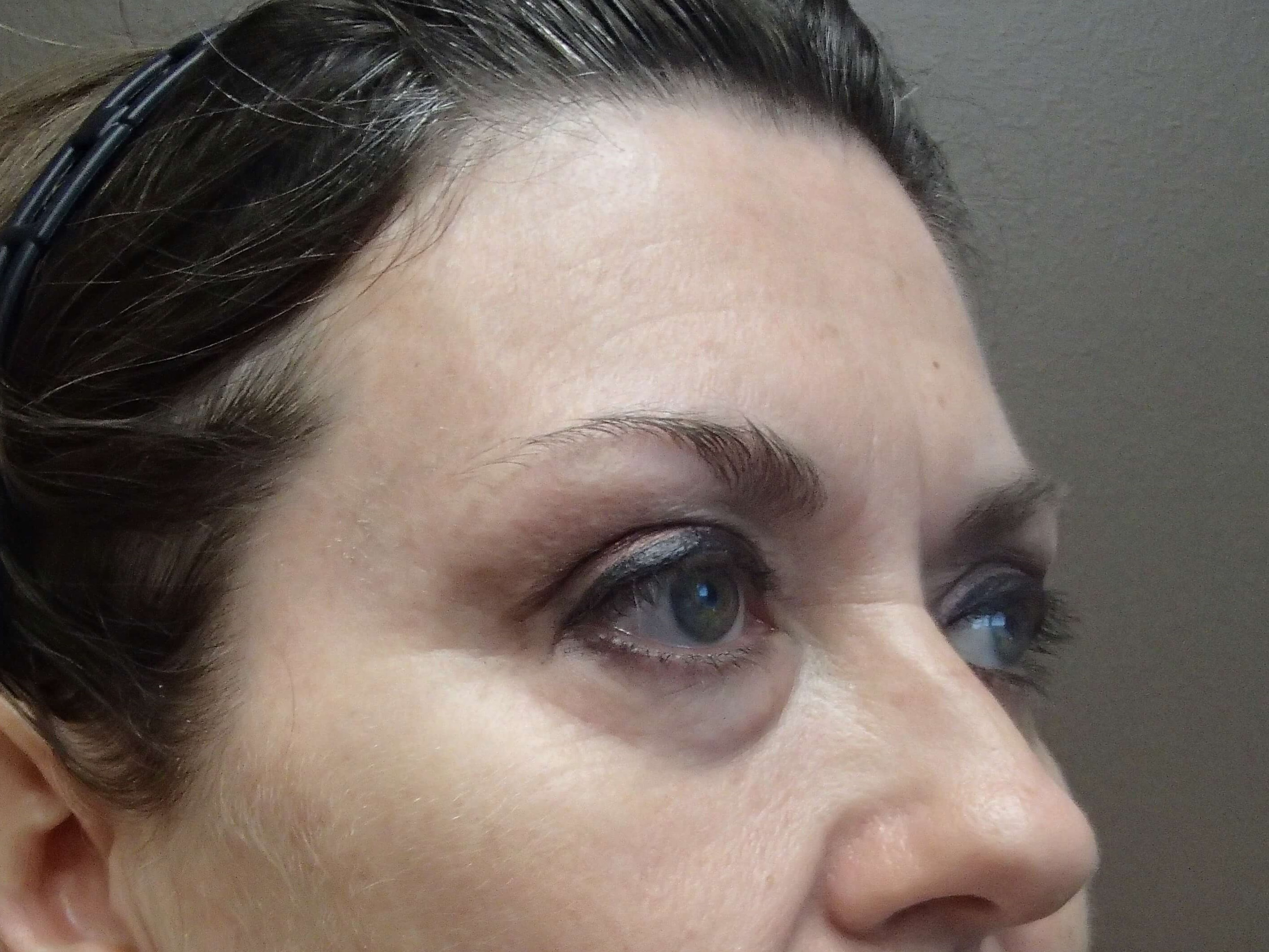 Browlift w/ Eyelid Lift Before