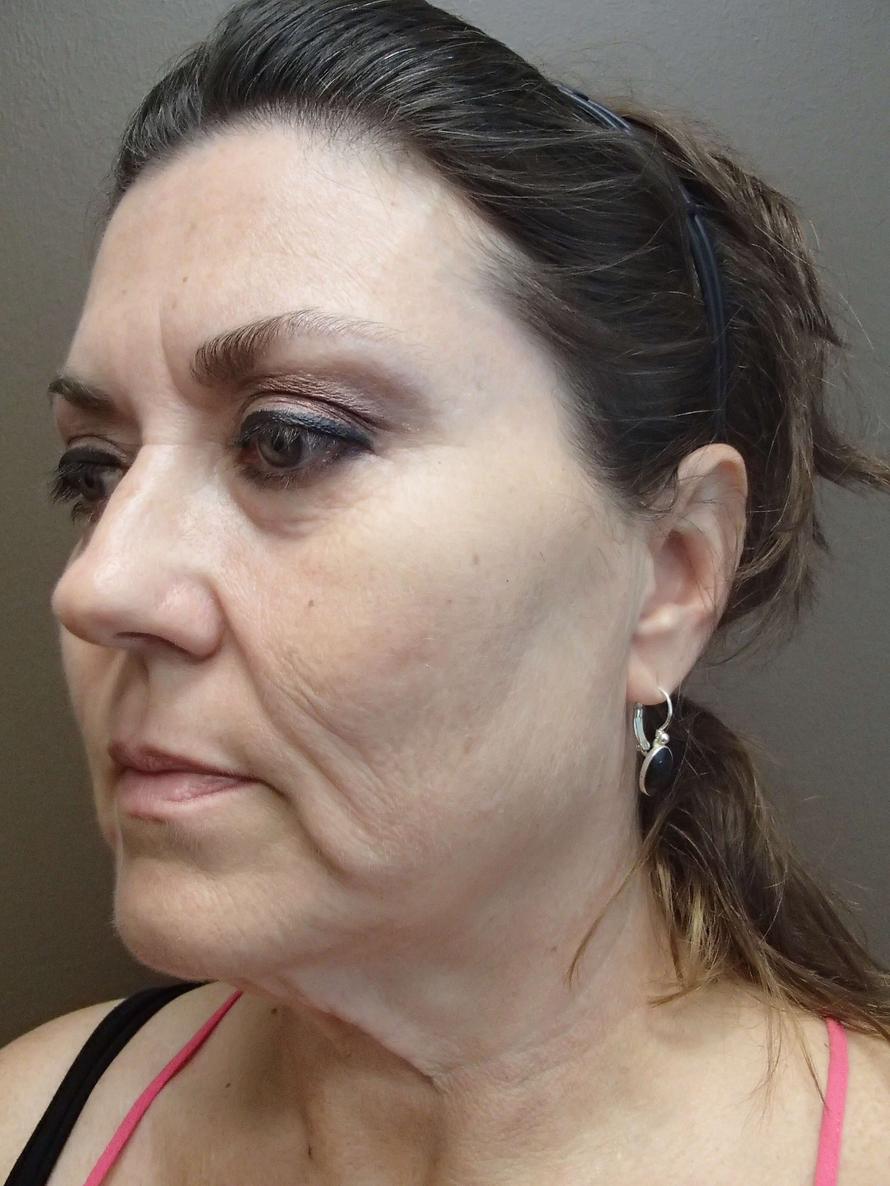 Browlift w/ Eyelid Lift Before