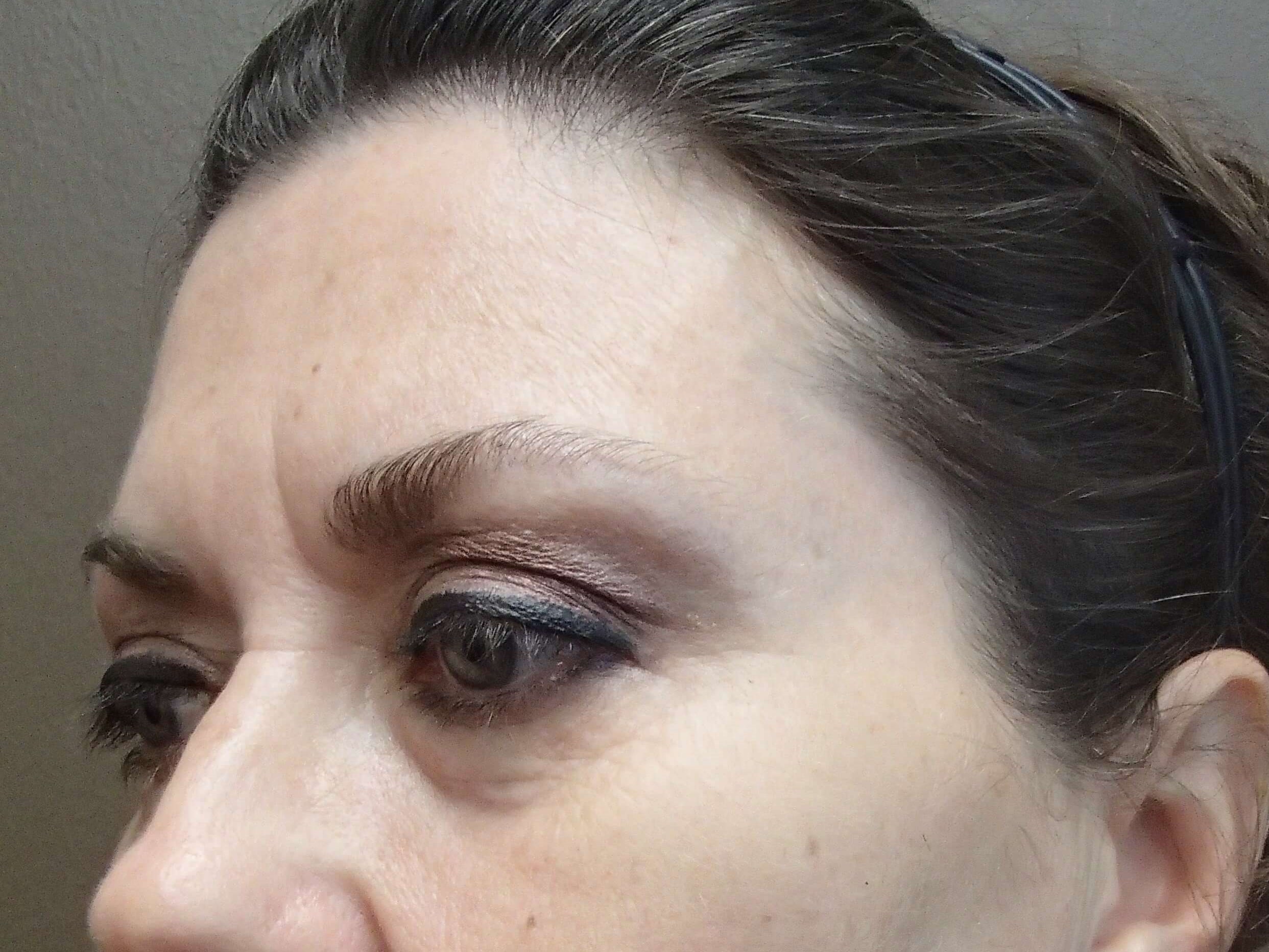 Browlift w/ Eyelid Lift Before