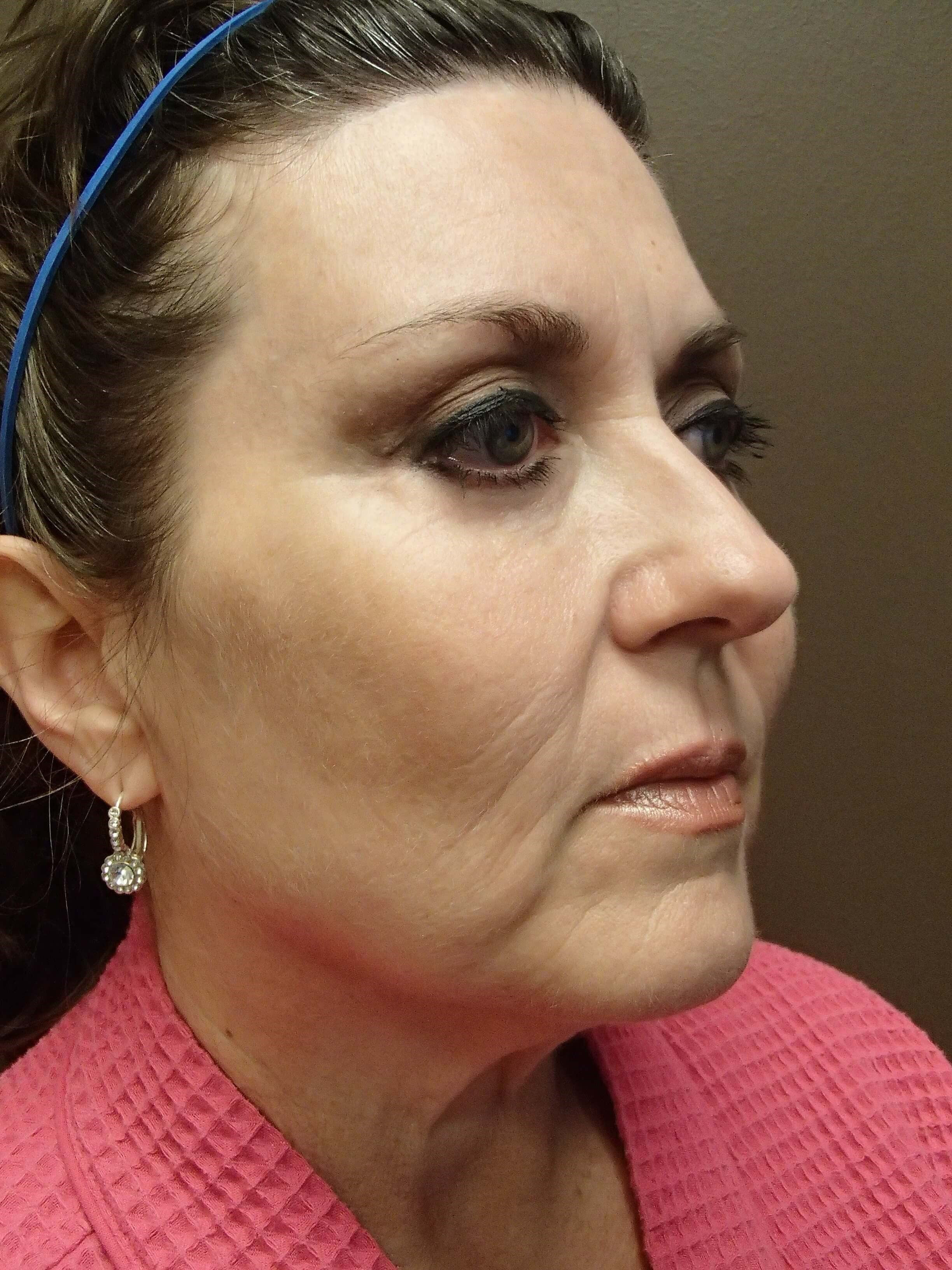 Browlift w/ Eyelid Lift After