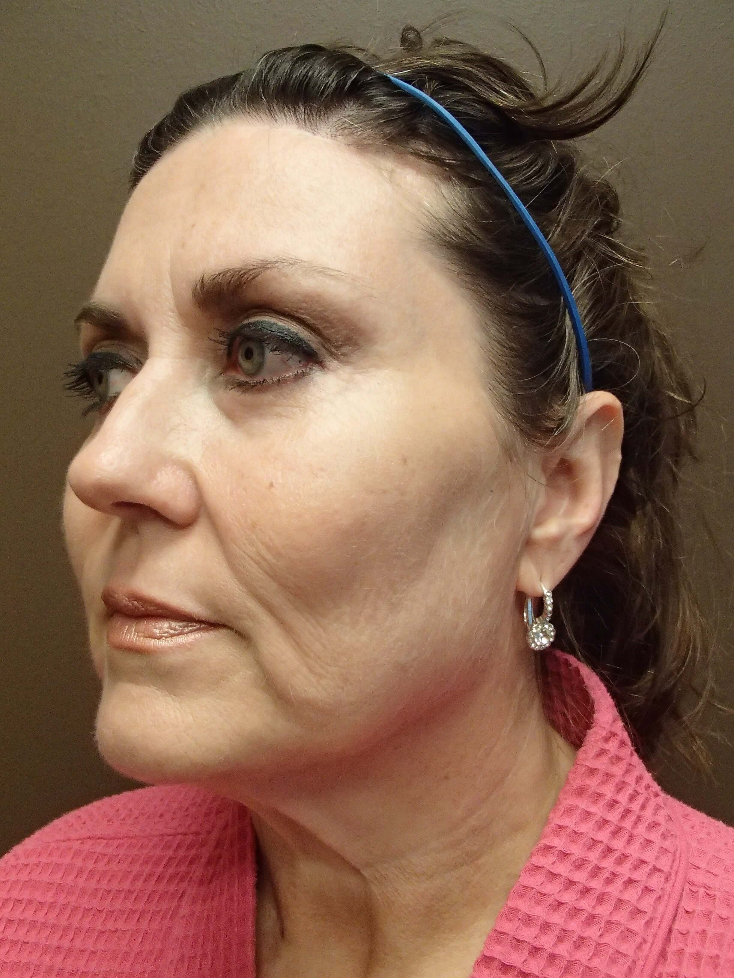 Browlift w/ Eyelid Lift After