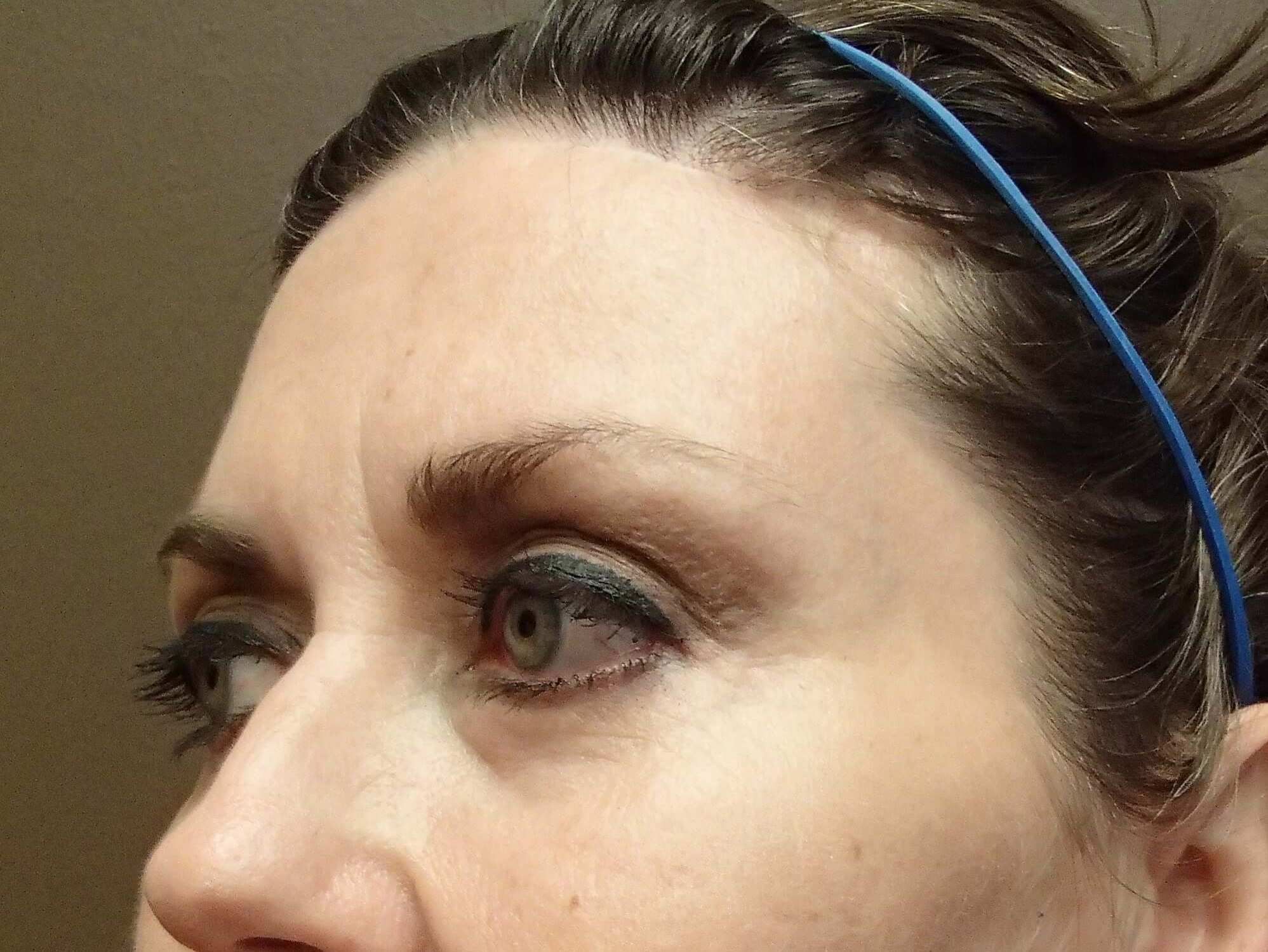 Browlift w/ Eyelid Lift After