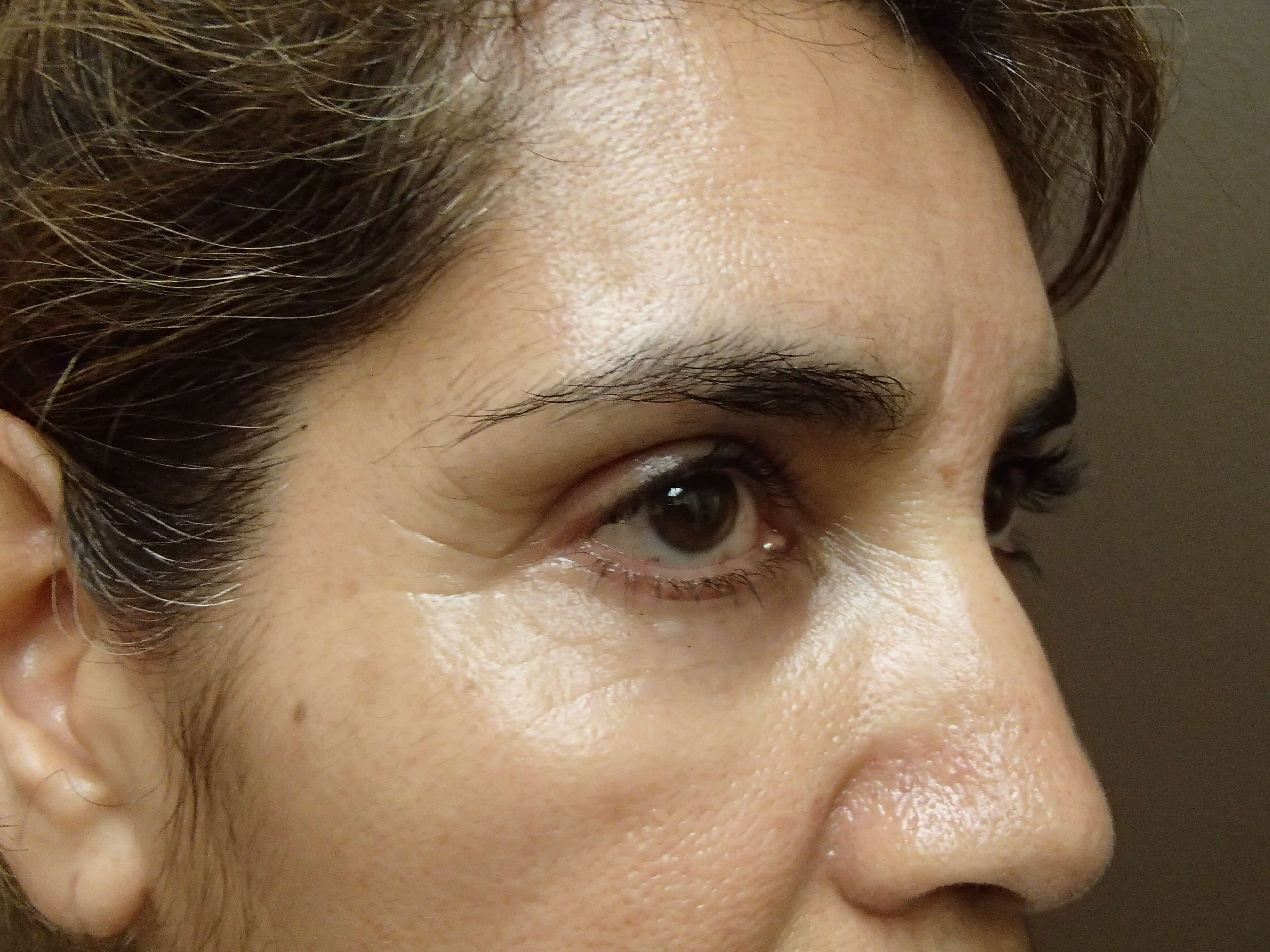 Browlift w/ Eyelid Lift After