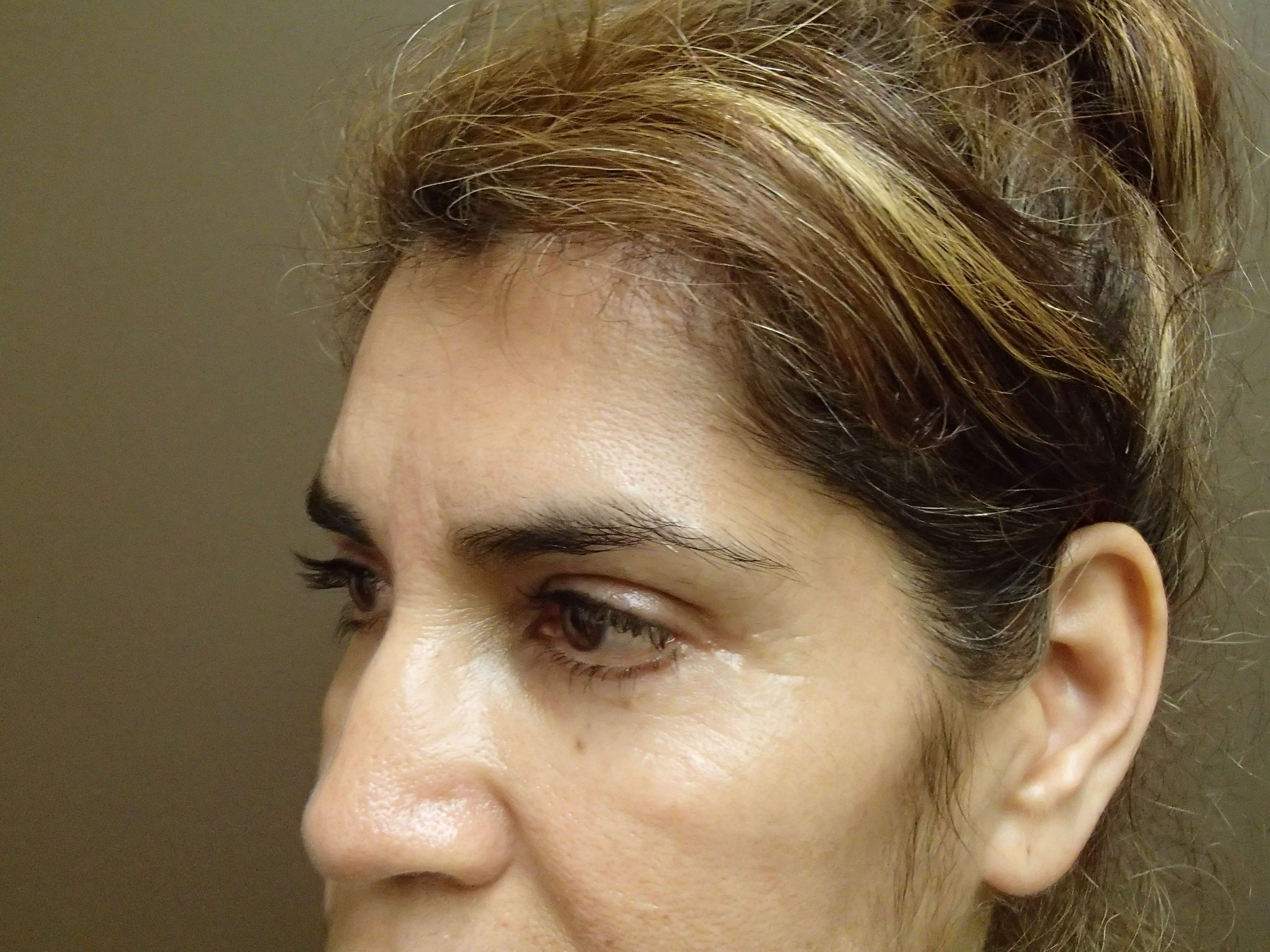 Browlift w/ Eyelid Lift After