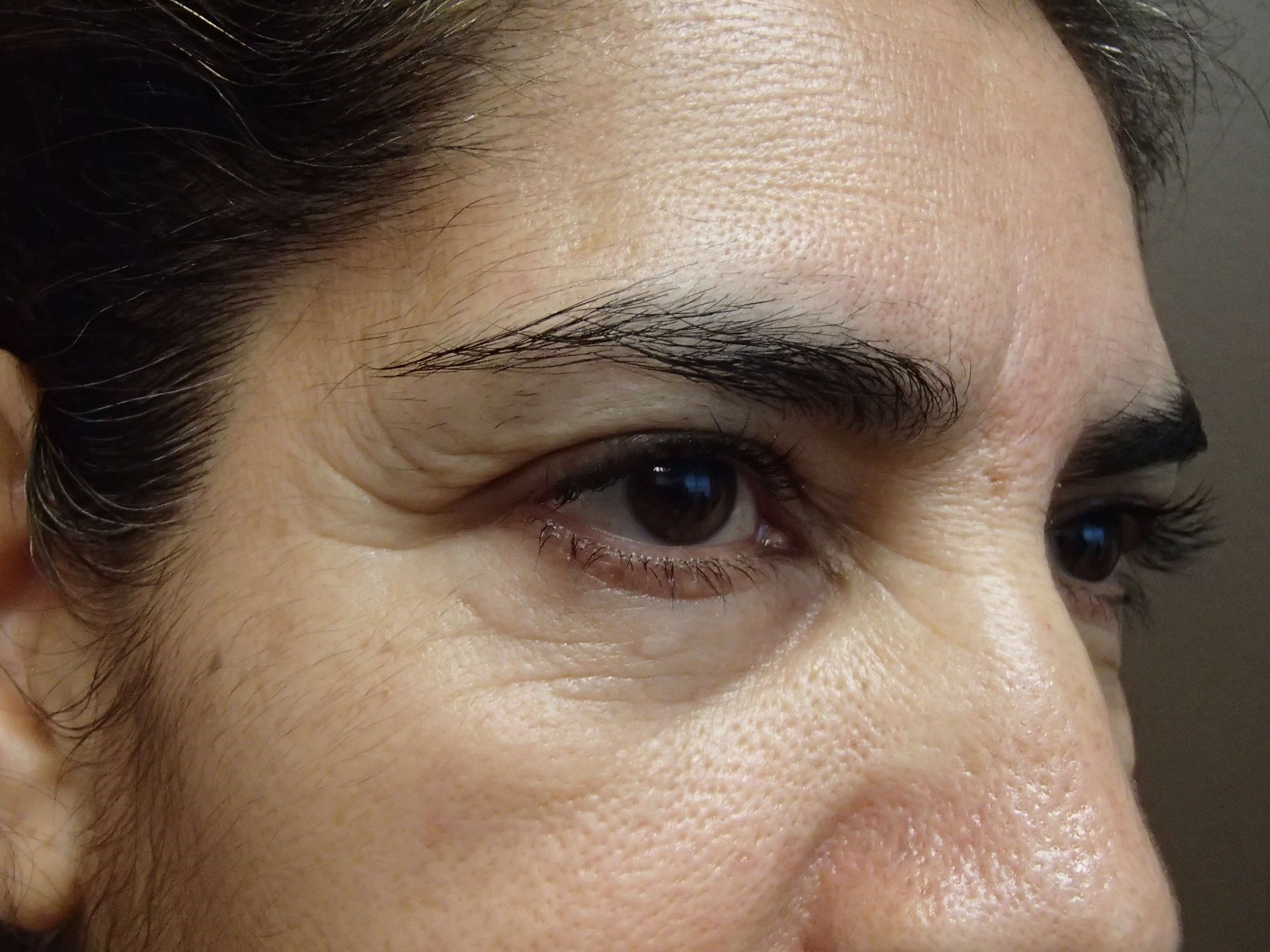 Browlift w/ Eyelid Lift Before