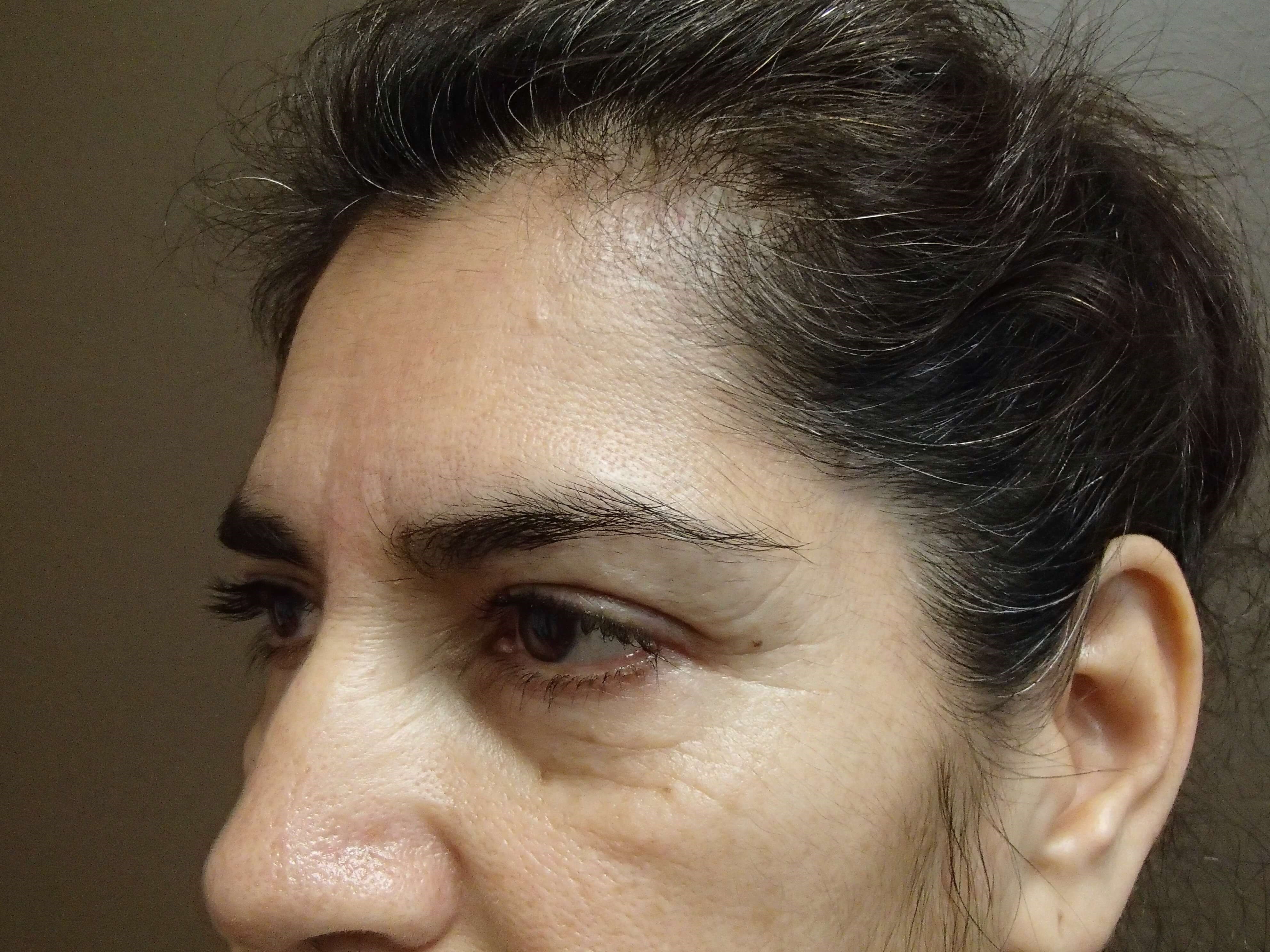 Browlift w/ Eyelid Lift Before