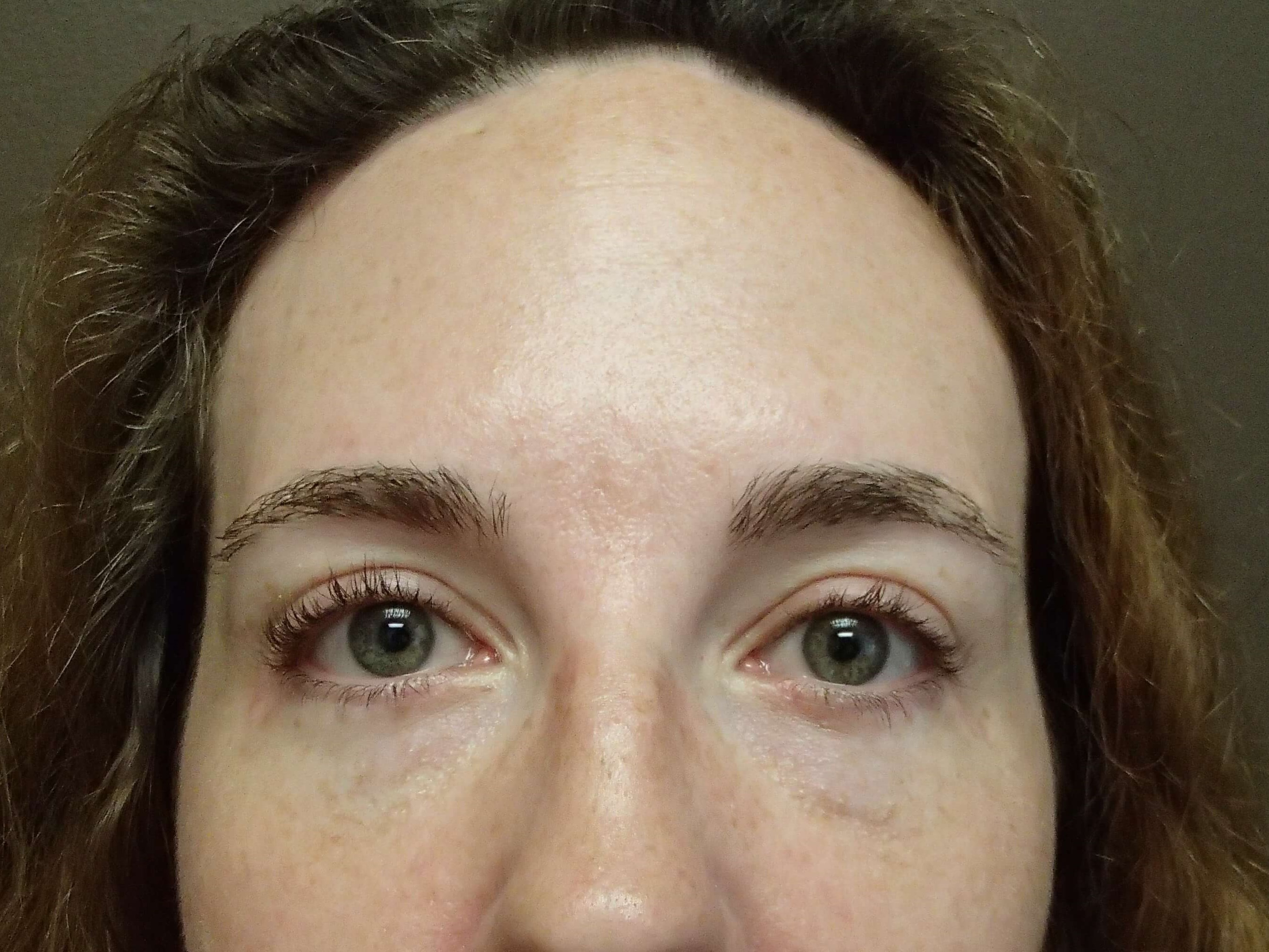 Browlift w/ Eyelid Lift After